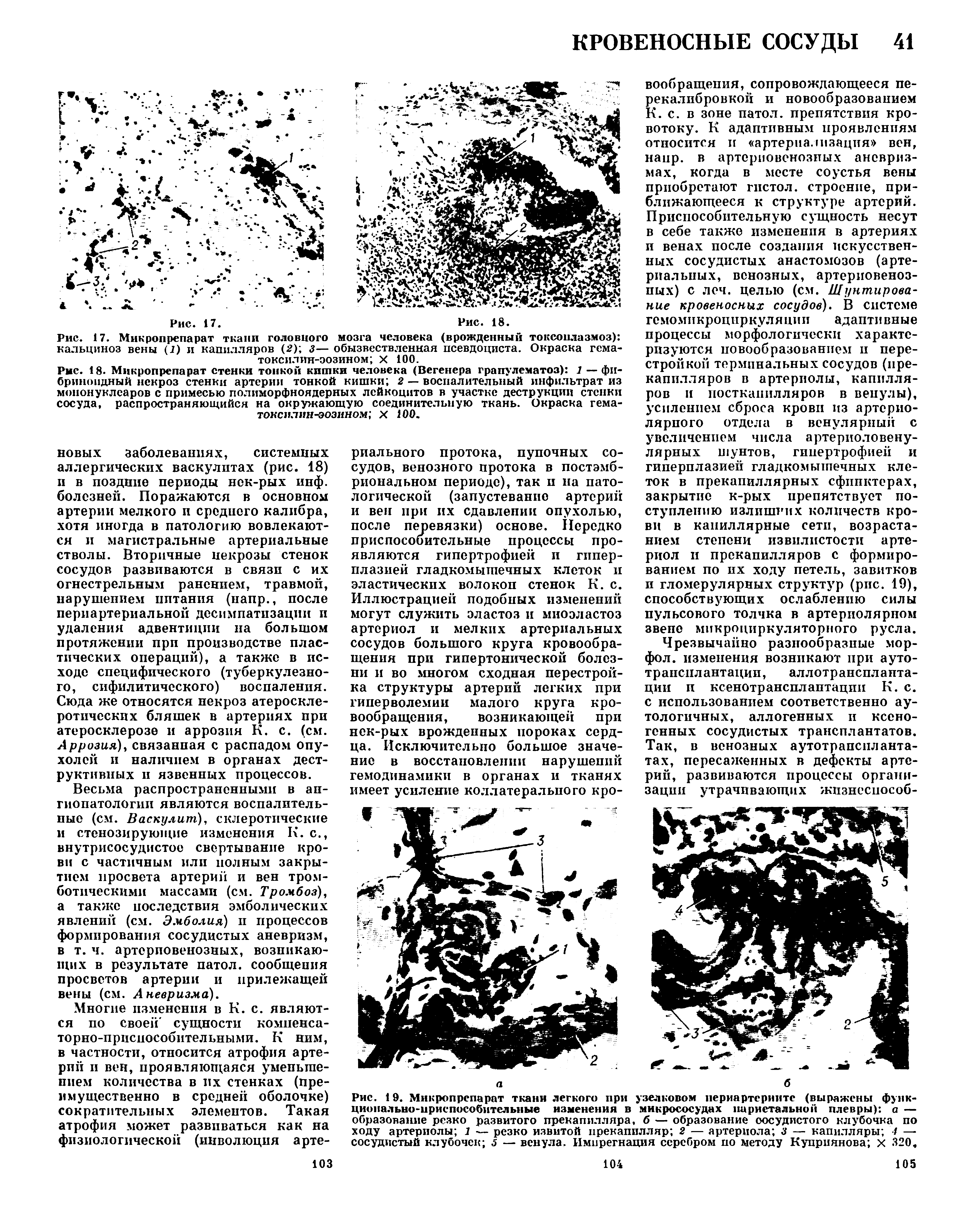 Рис. 17. Микропрепарат ткани головного мозга человека (врожденный токсоплазмоз) кальциноз вены (7) и капилляров (2) з— обызвествленная псевдоциста. Окраска гема-токсилин-эозином X 100.