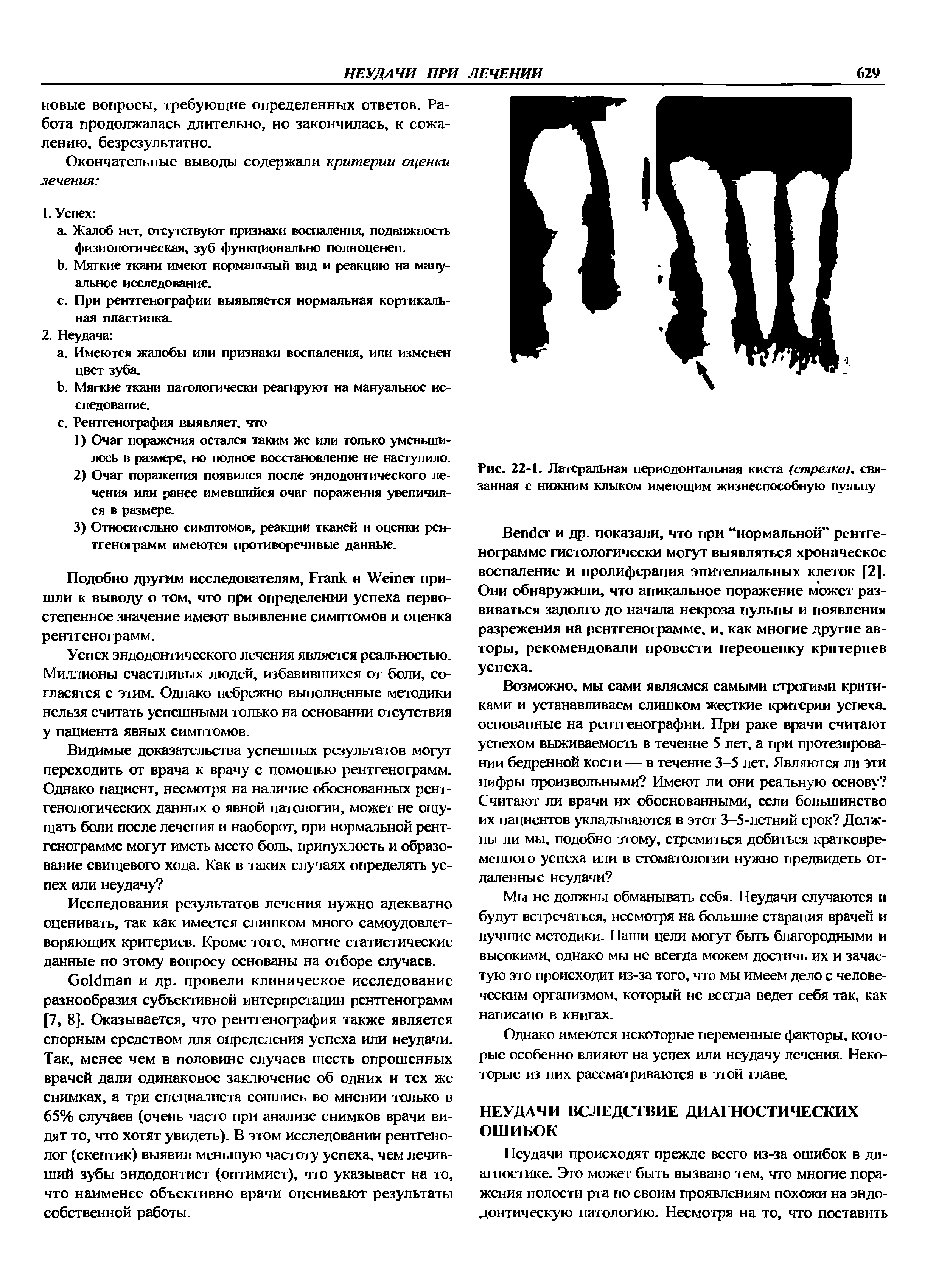 Рис. 22-1. Латеральная периодонтальная киста (стрелка , связанная с нижним клыком имеющим жизнеспособную пульпу...