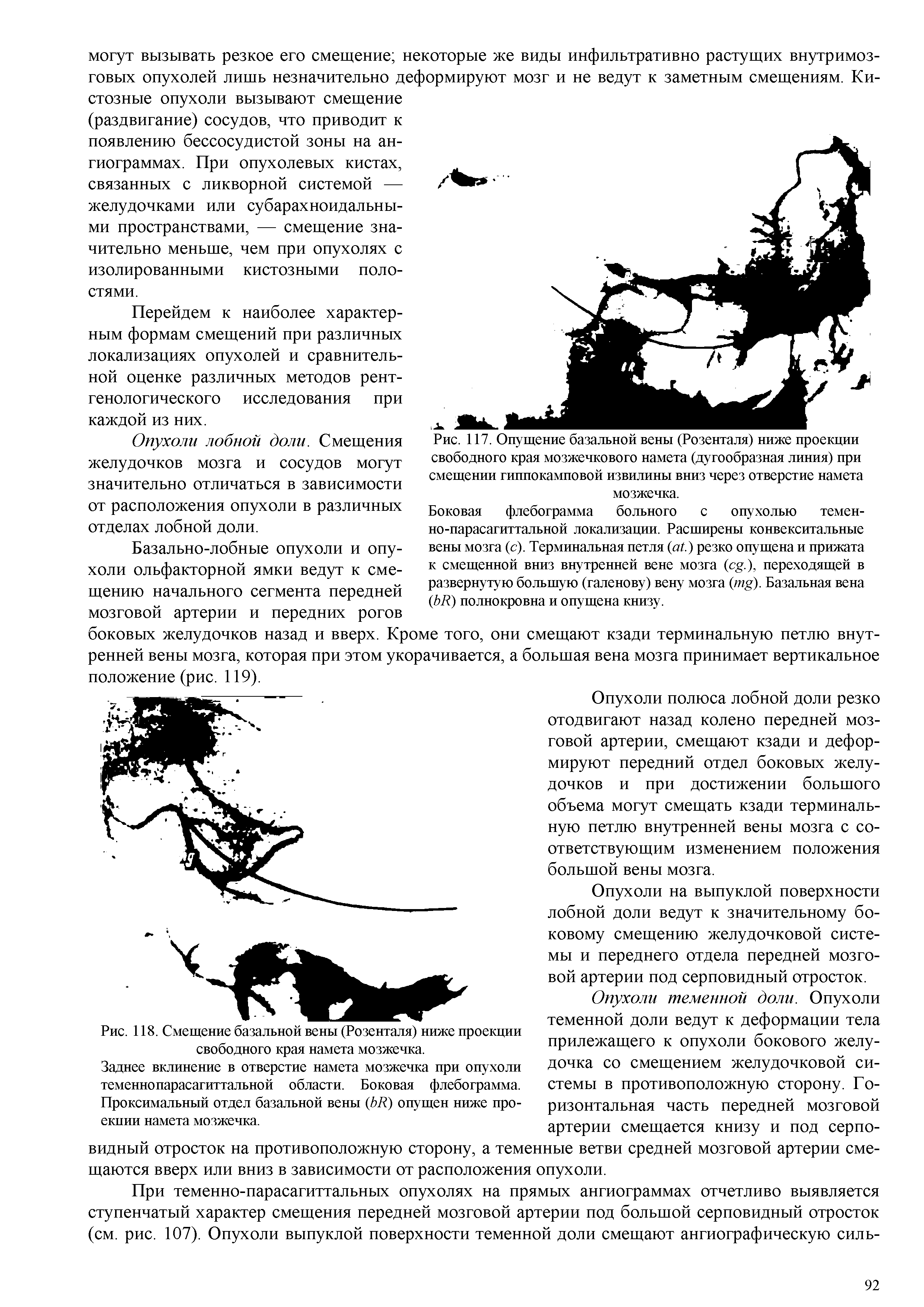 Рис. 118. Смещение базальной вены (Розенталя) ниже проекции свободного края намета мозжечка.