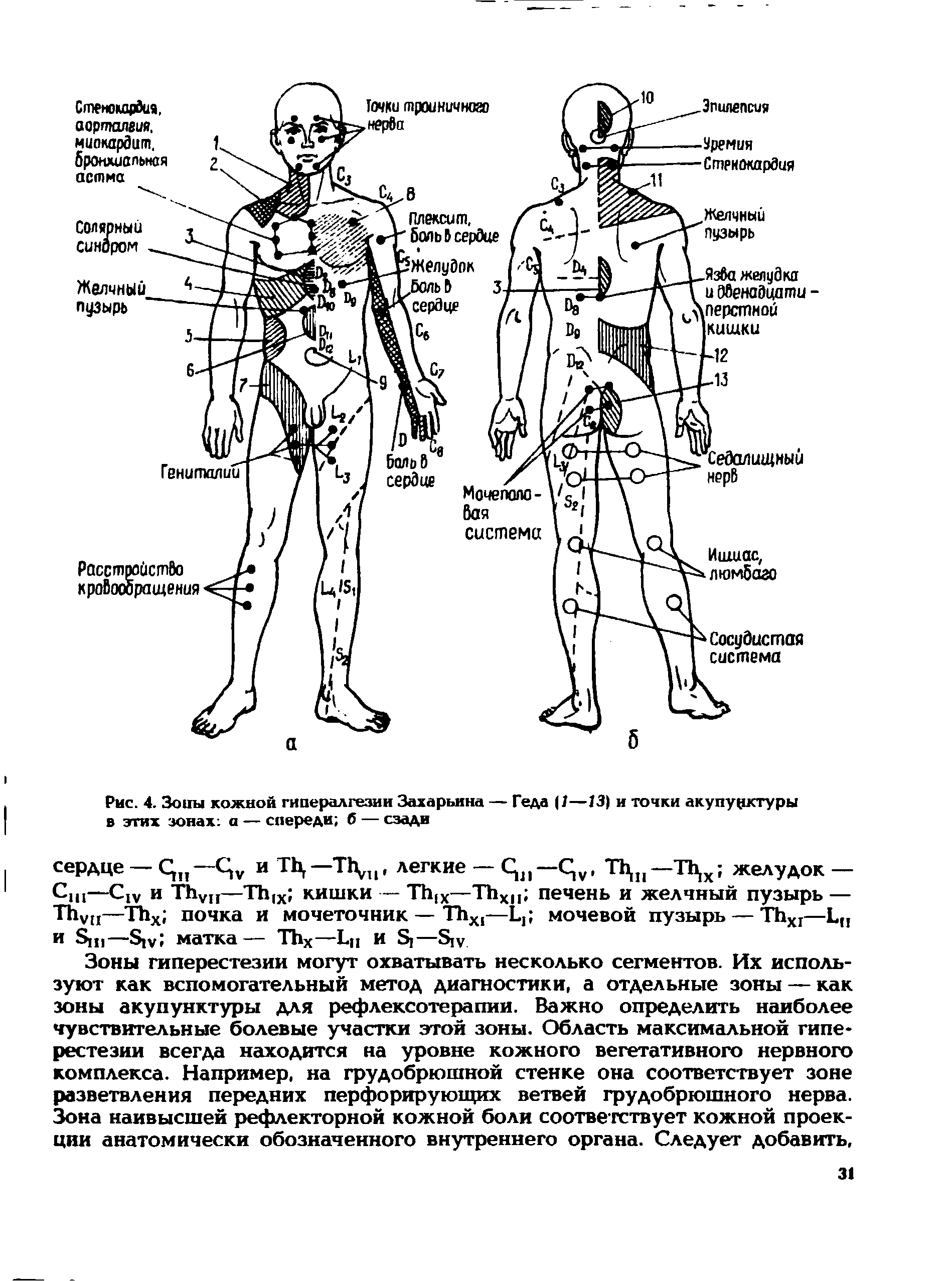 Рис. 4. Зоны кожной гипералгезии Захарьина — Геда (1—13) и точки акупунктуры в этих зонах а — спереди б — сзади...