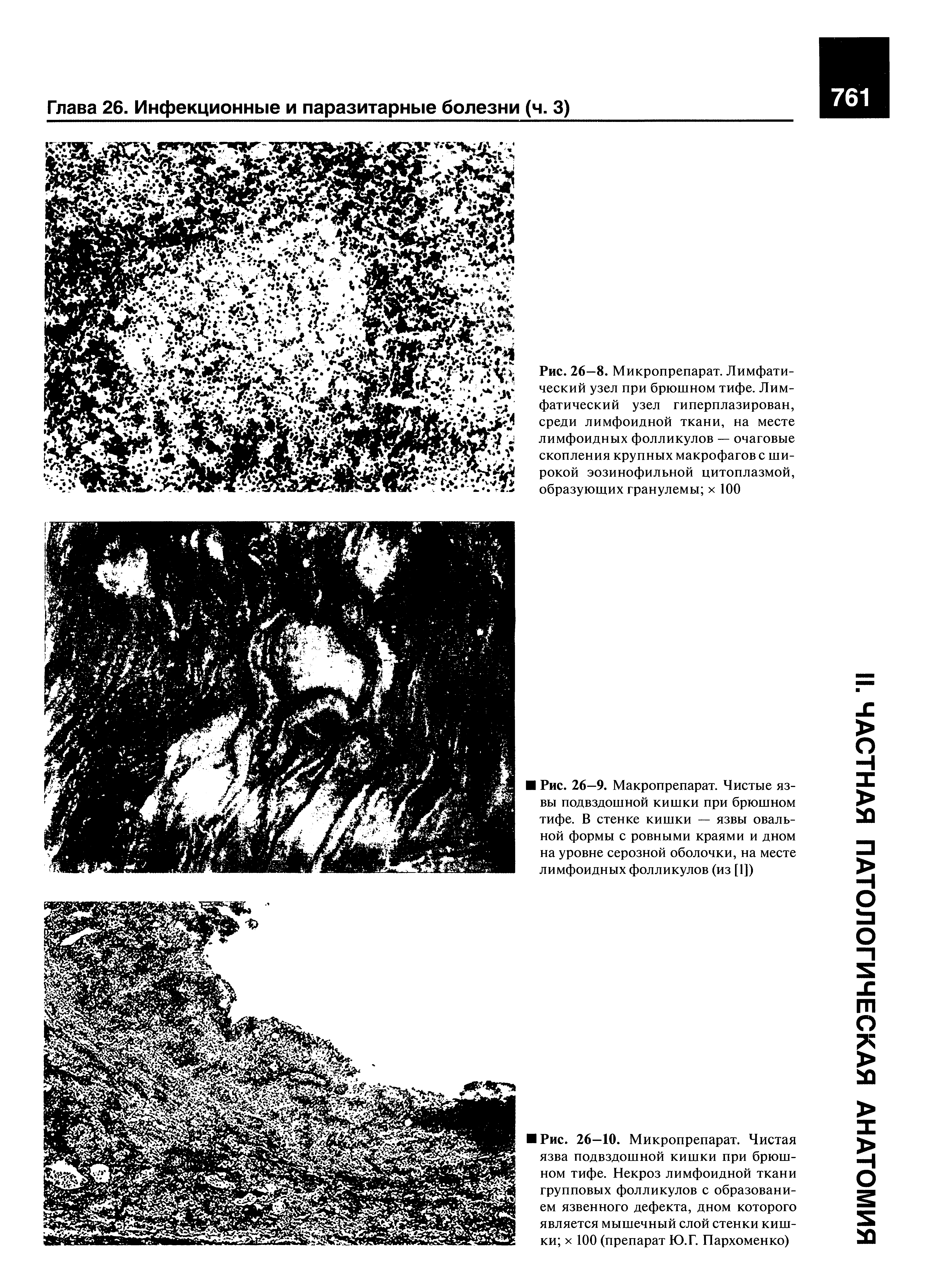 Рис. 26—8. Микропрепарат. Лимфатический узел при брюшном тифе. Лимфатический узел гиперплазирован, среди лимфоидной ткани, на месте лимфоидных фолликулов — очаговые скопления крупных макрофагов с широкой эозинофильной цитоплазмой, образующих гранулемы х 100...