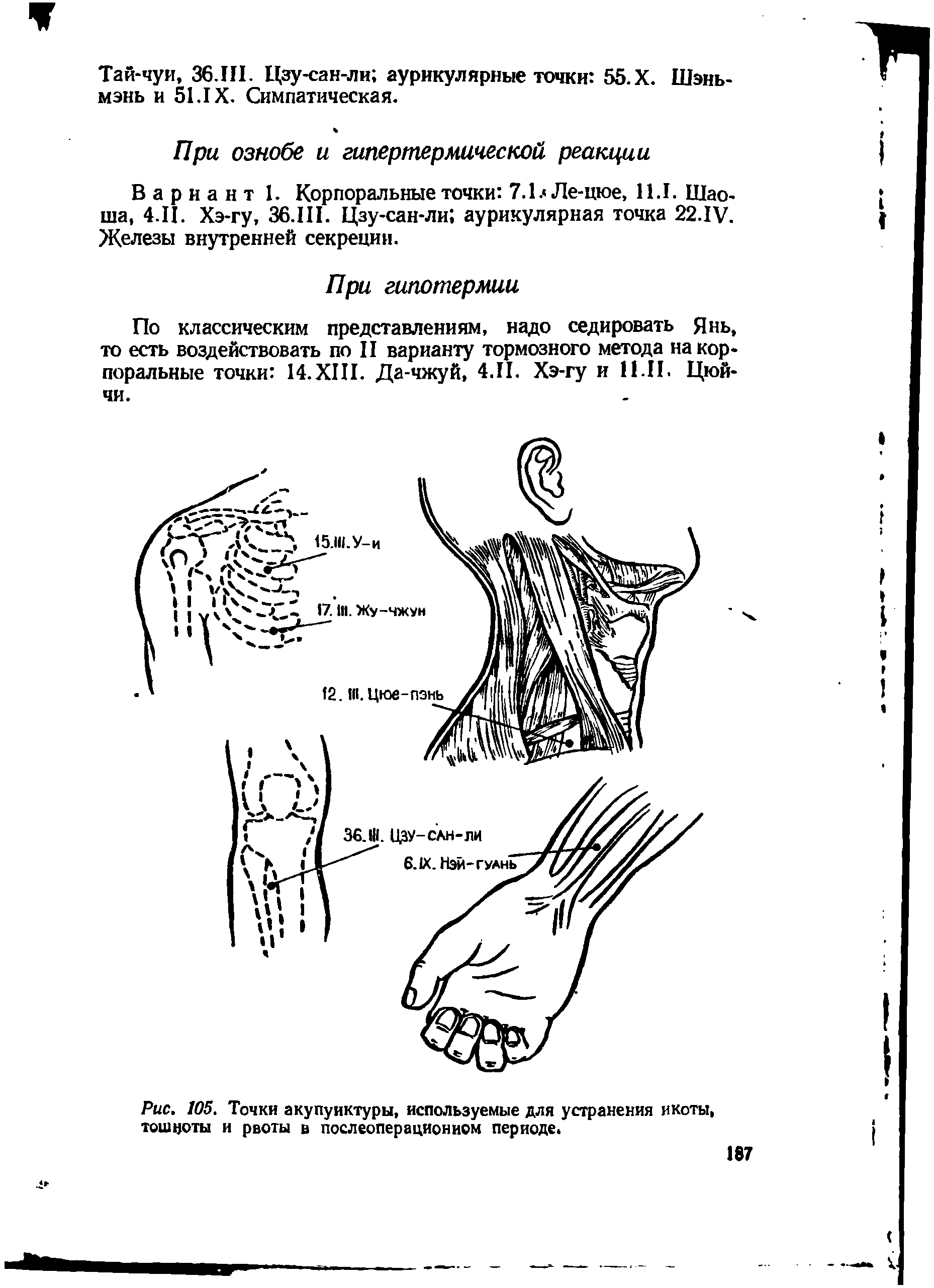 Рис. 105. Точки акупунктуры, используемые для устранения икоты, тошноты и рвоты в послеоперационном периоде.