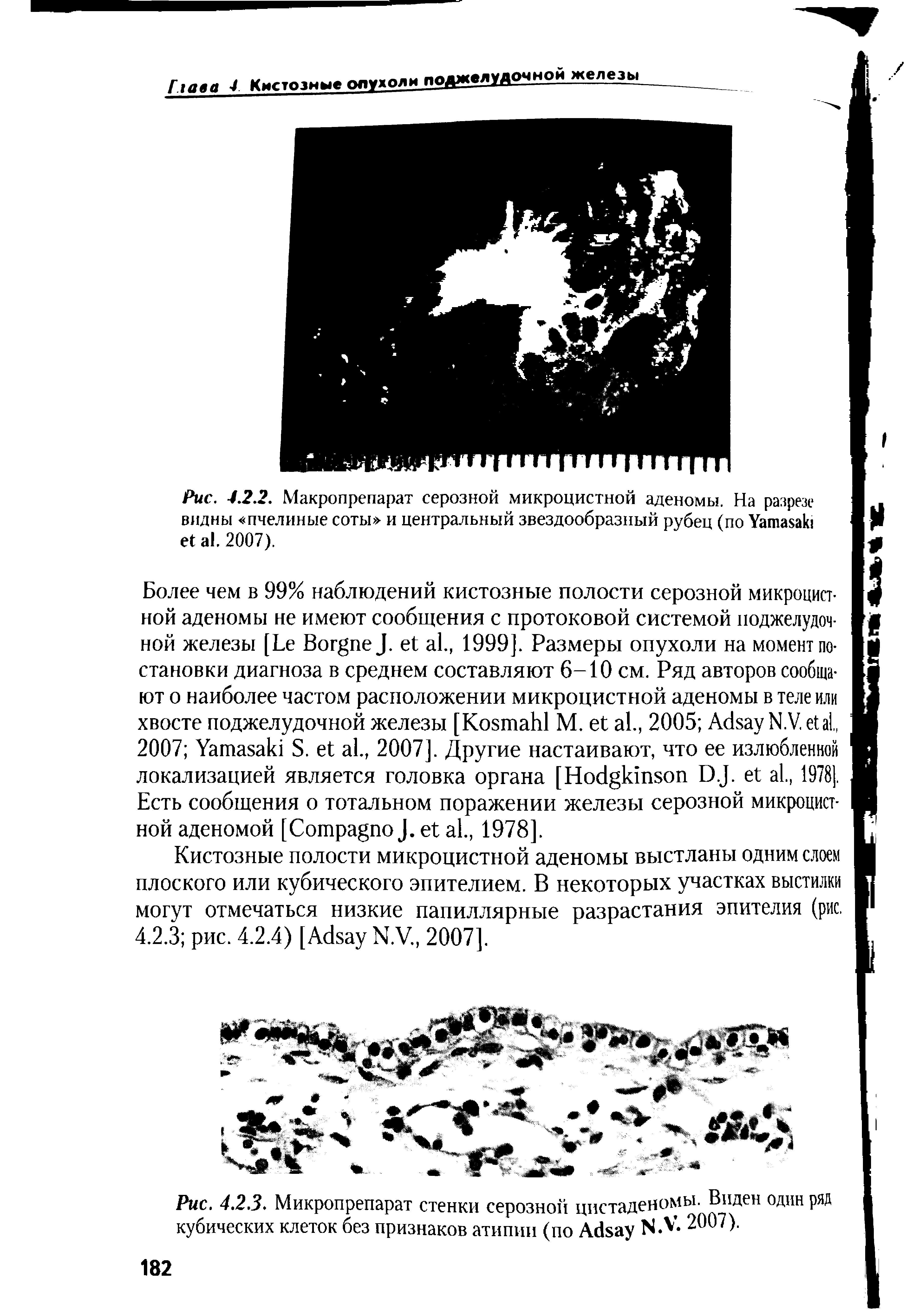 Рис. 4.2.3. Микропрепарат стенки серозной цистаденомы. Виден один ряд кубических клеток без признаков атипии (по Айзау К 2007).