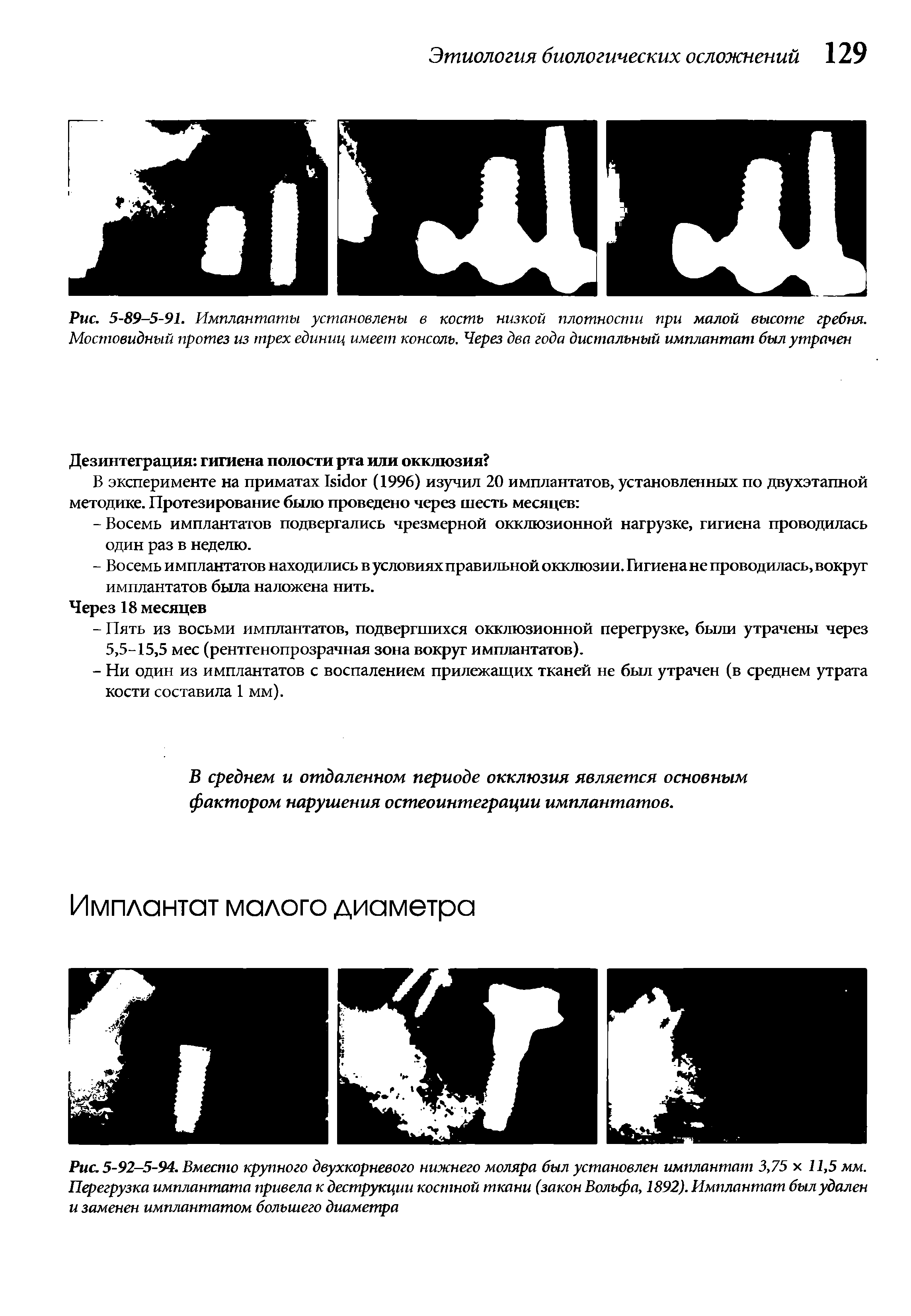 Рис. 5-92-5-94. Вместо крупного двухкорневого нижнего моляра был установлен имплантат 3,75 х 11,5 мм. Перегрузка имплантата привела к деструкции костной ткани (закон Вольфа, 1892). Имплантат был удален и заменен имплантатом большего диаметра...