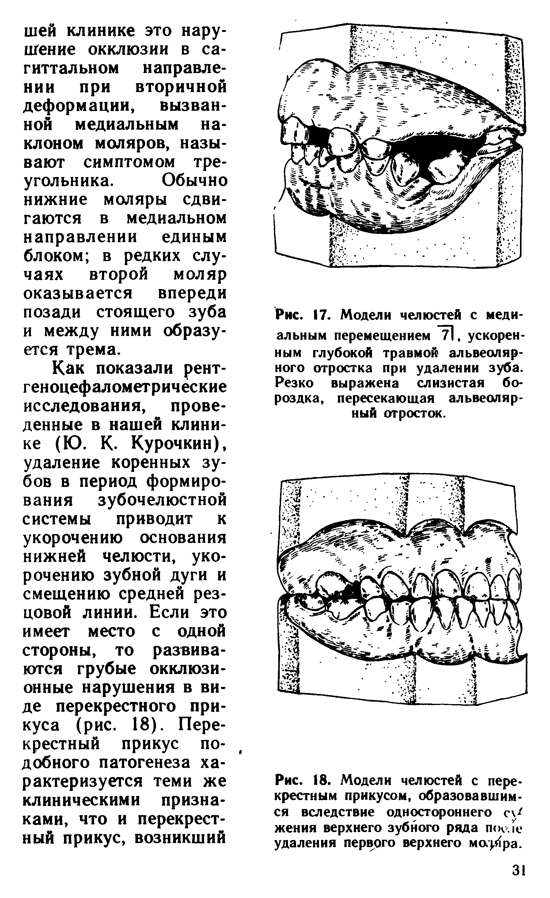 Рис. 17. Модели челюстей с медиальным перемещением "71, ускоренным глубокой травмой альвеолярного отростка при удалении зуба. Резко выражена слизистая бороздка, пересекающая альвеолярный отросток.