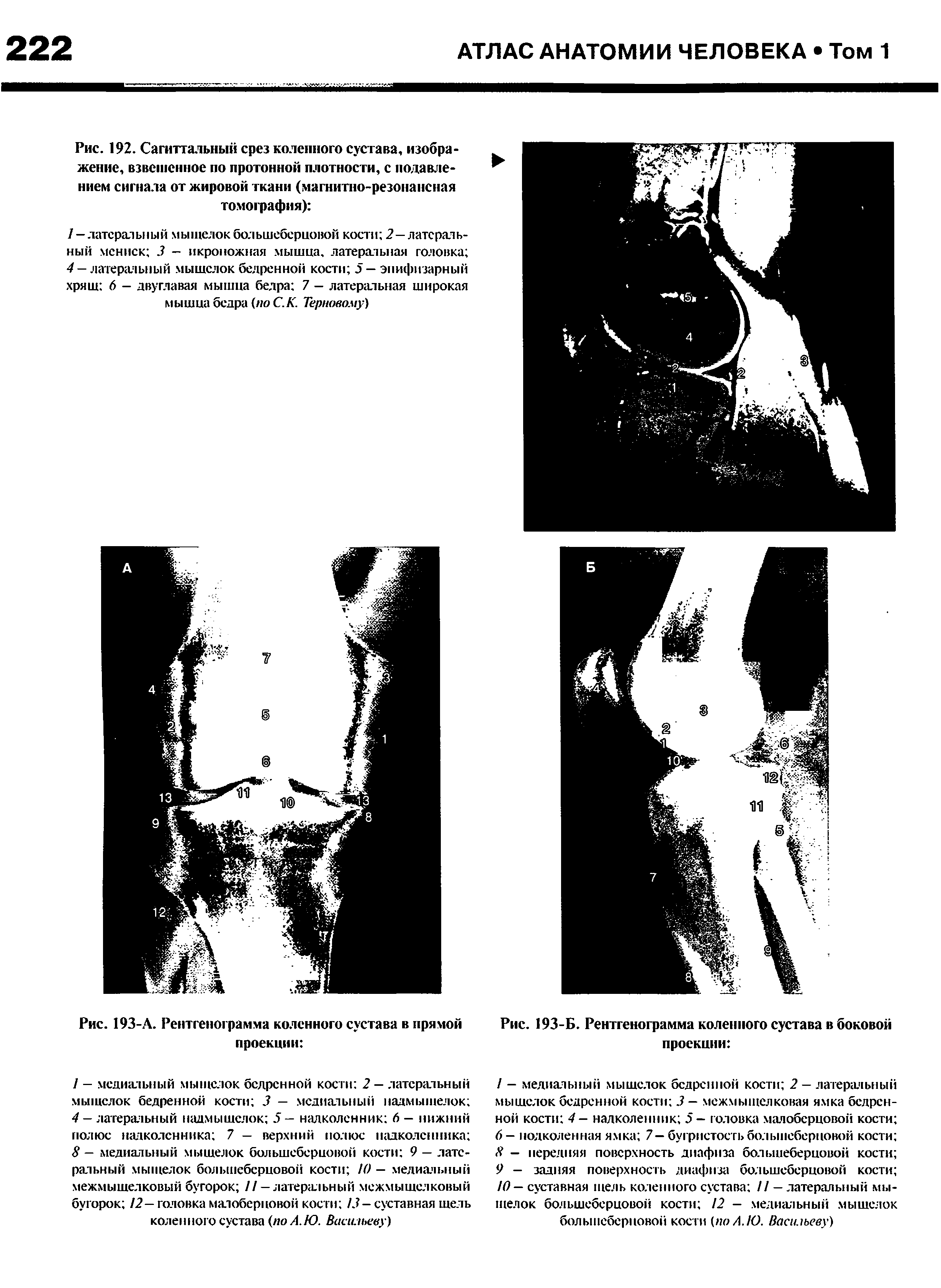 Рис. 192. Сагиттальный срез коленного сустава, изображение, взвешенное по протонной плотности, с подавлением сигнала от жировой гкани (магнитно-резонансная томография) ...
