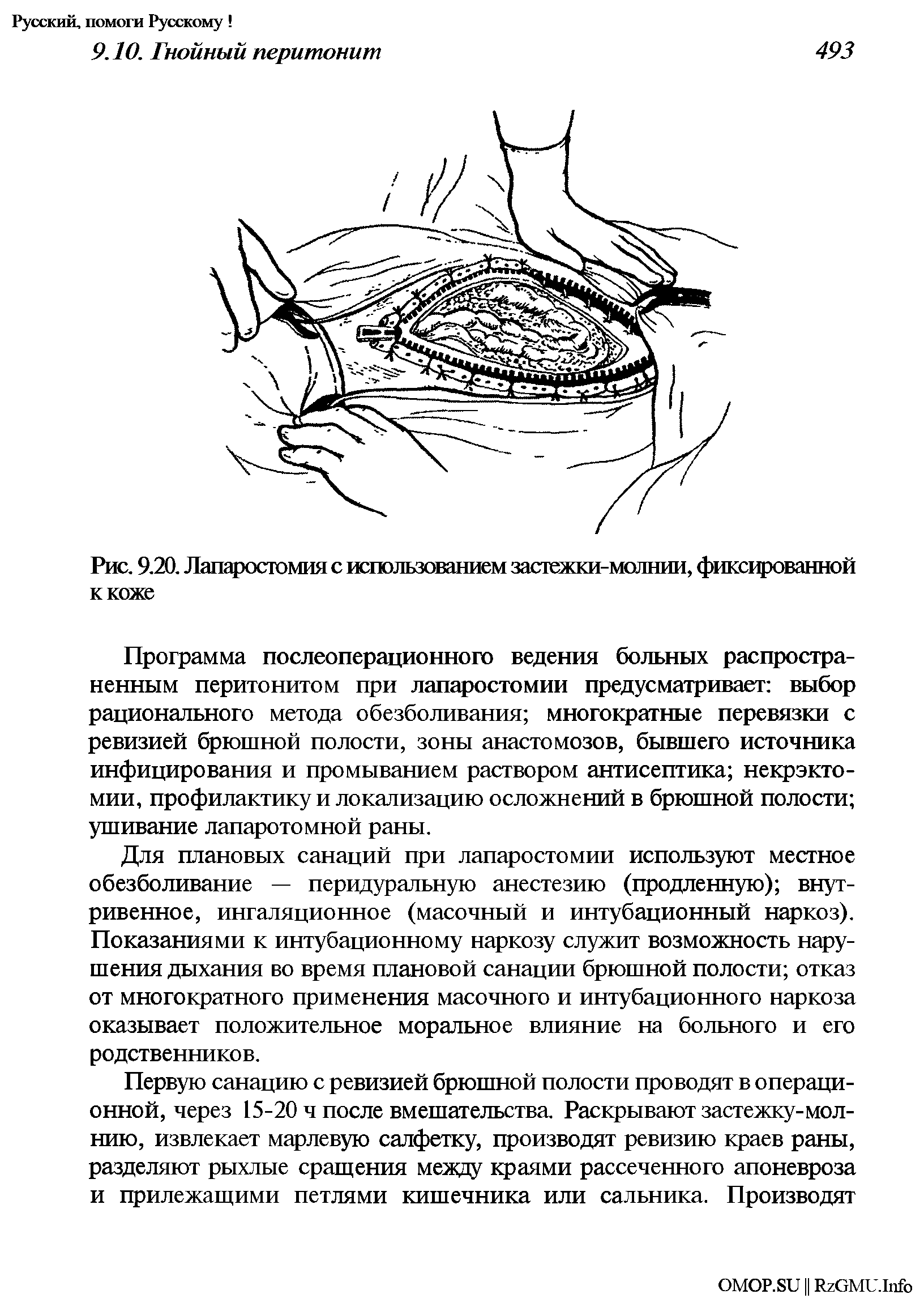 Рис. 9.20. Лапаростомия с использованием застежки-молнии, фиксированной к коже...