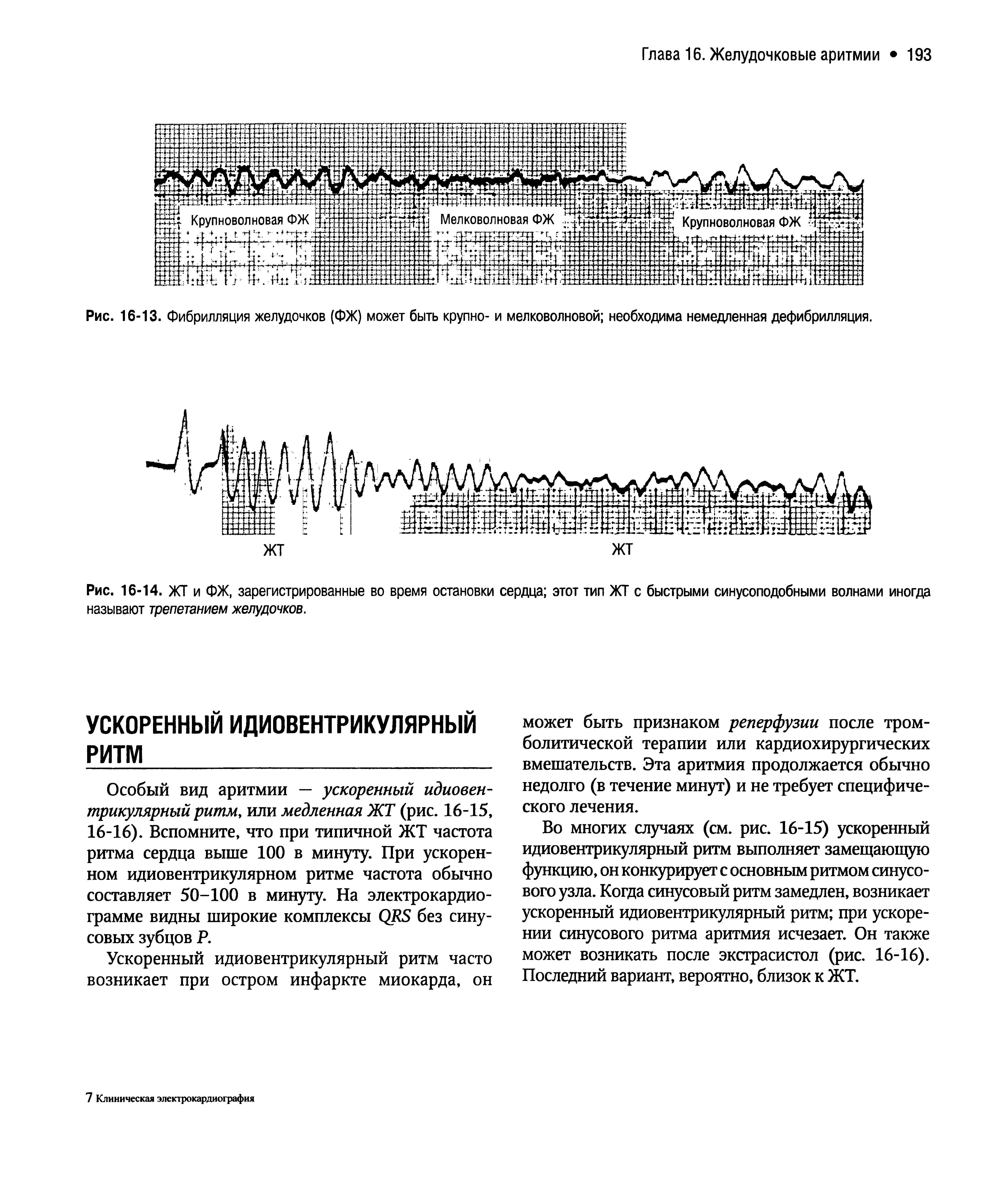 Рис. 16-14. ЖТ и ФЖ, зарегистрированные во время остановки сердца этот тип ЖТ с быстрыми синусоподобными волнами иногда называют трепетанием желудочков.