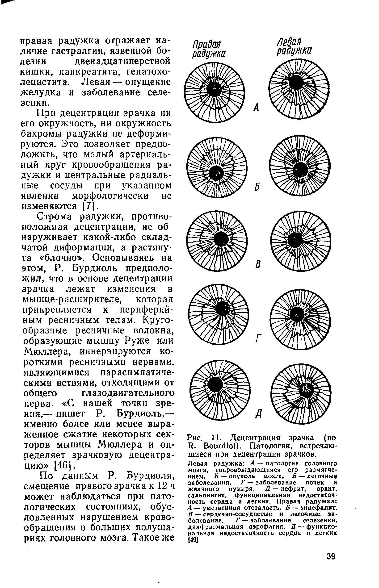 Рис. 11. Децентрации зрачка (по Я. Воиг<По1). Патологии, встречающиеся при децентрации зрачков.