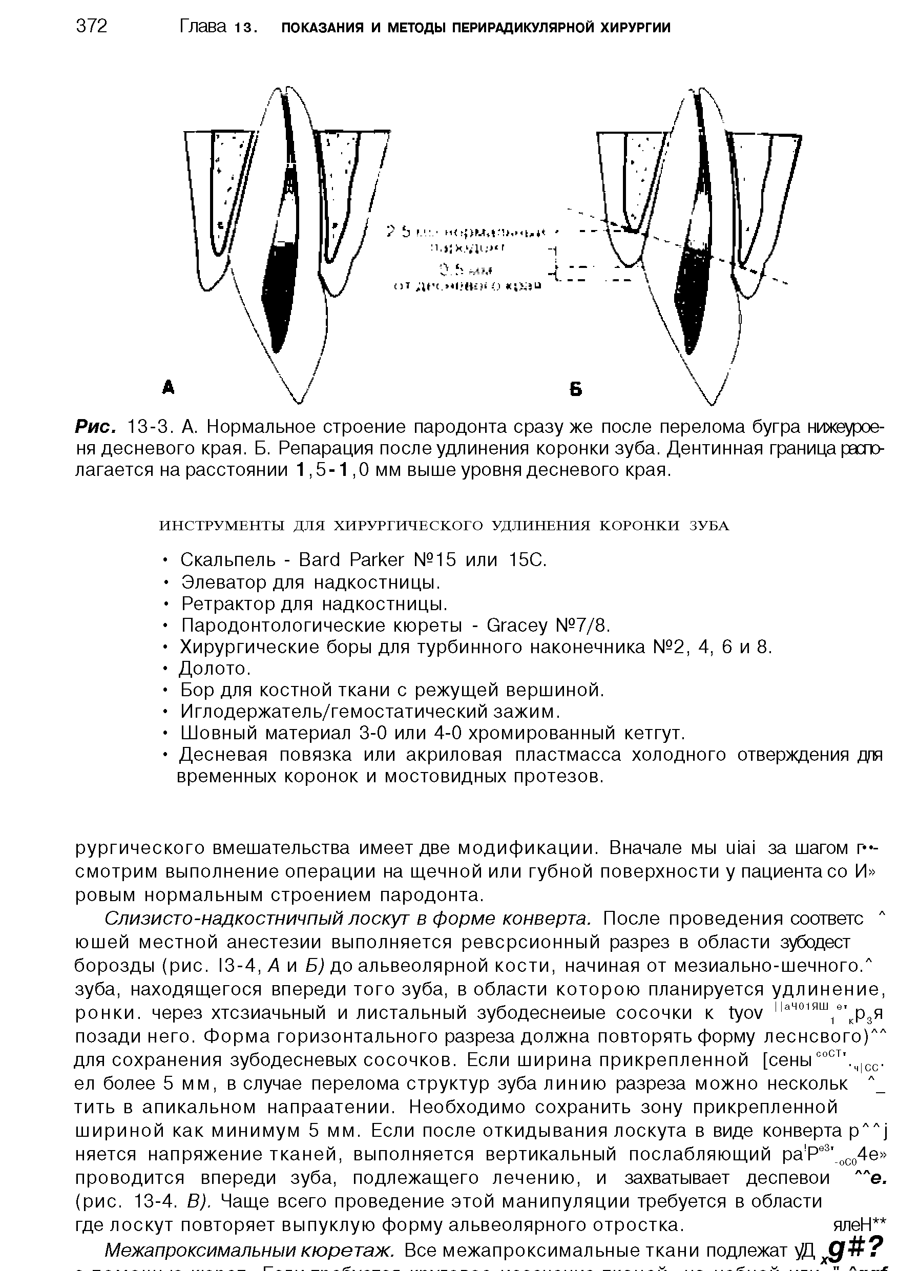 Рис. 13-3. А. Нормальное строение пародонта сразу же после перелома бугра нижеурое-ня десневого края. Б. Репарация после удлинения коронки зуба. Дентинная граница располагается на расстоянии 1,5-1,0 мм выше уровня десневого края.
