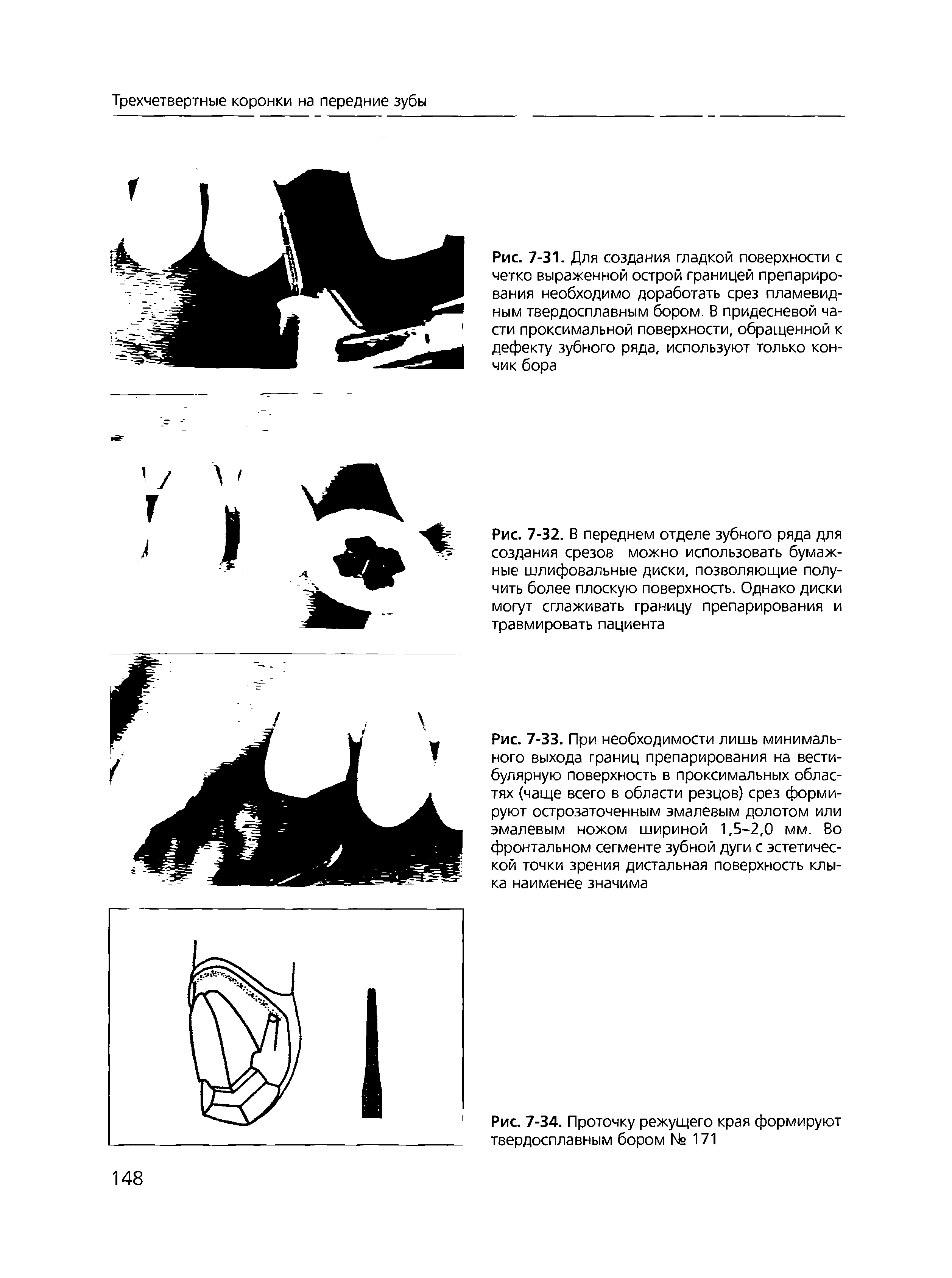 Рис. 7-31. Для создания гладкой поверхности с четко выраженной острой границей препарирования необходимо доработать срез пламевидным твердосплавным бором. В придесневой части проксимальной поверхности, обращенной к дефекту зубного ряда, используют только кончик бора...