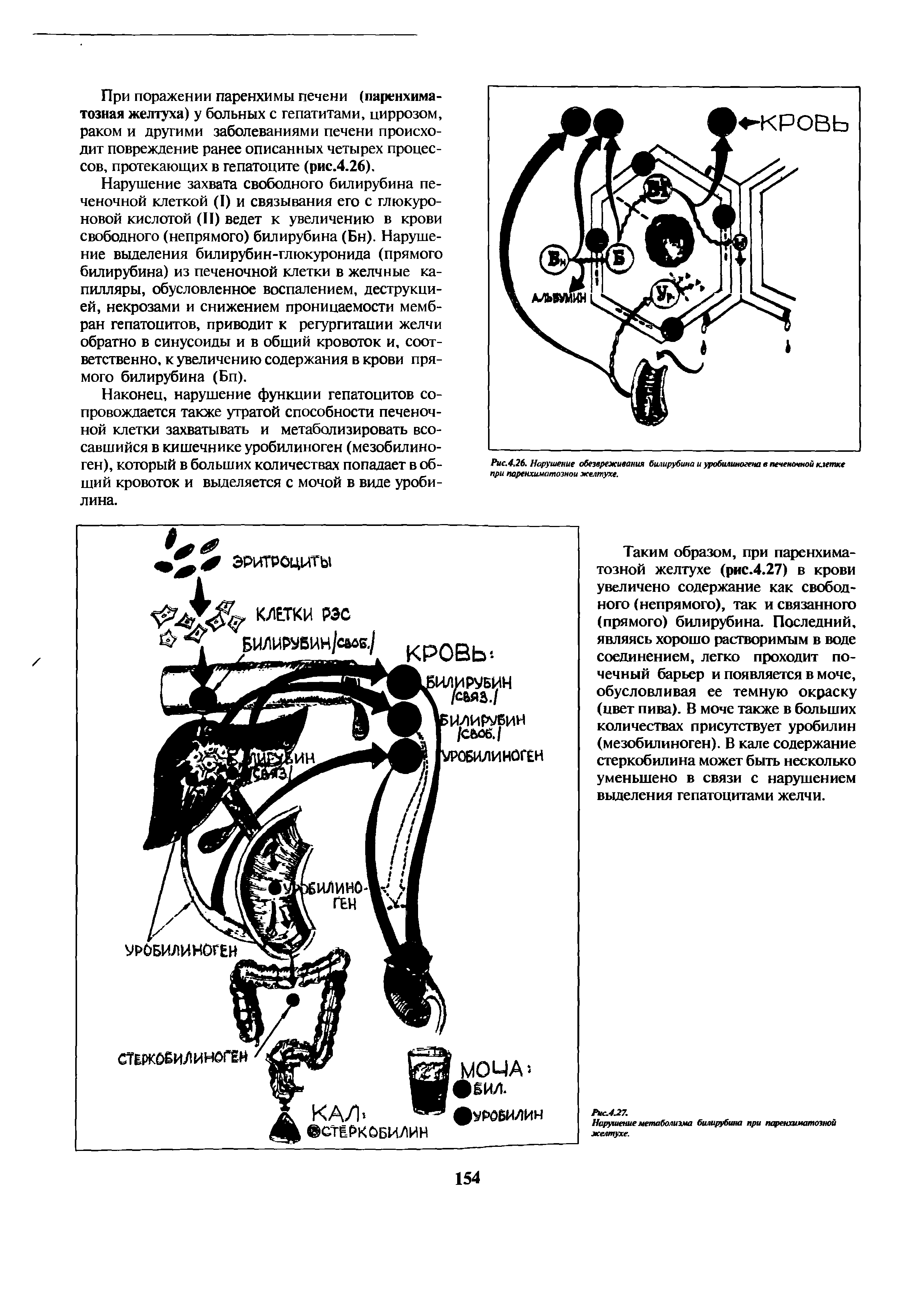 Рис.4,26. Нарушение обезвреживания билирубина и уробилиногена в печеночной клетке при паренхиматозной желтухе.