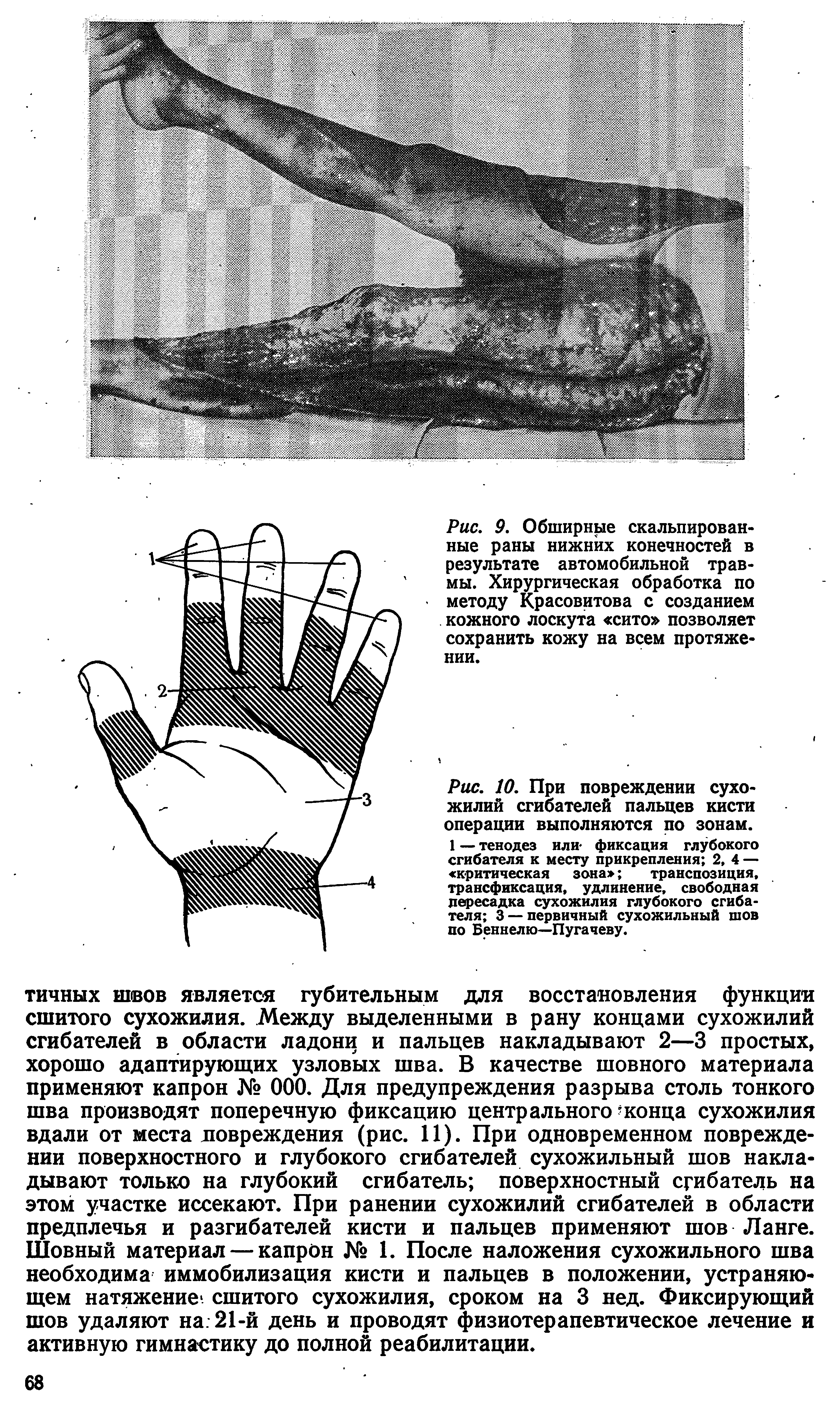 Рис. 10. При повреждении сухожилий сгибателей пальцев кисти операции выполняются по зонам.