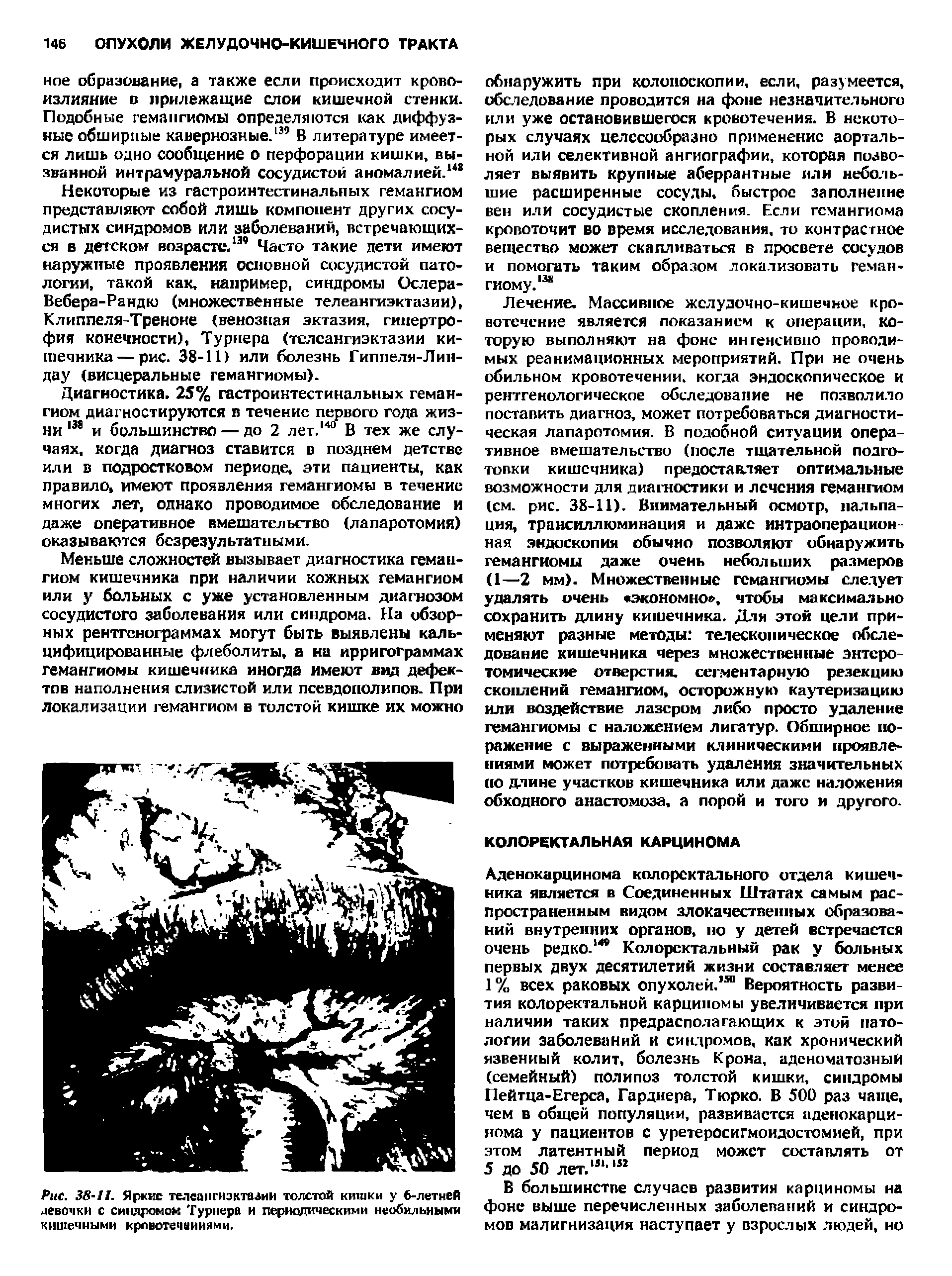 Рис. Зв-И. Яркие телеангиэктазия толстой кишки у 6-летней девочки с синдромом Турнера и периодическими необильными кишечными кровотечениями.