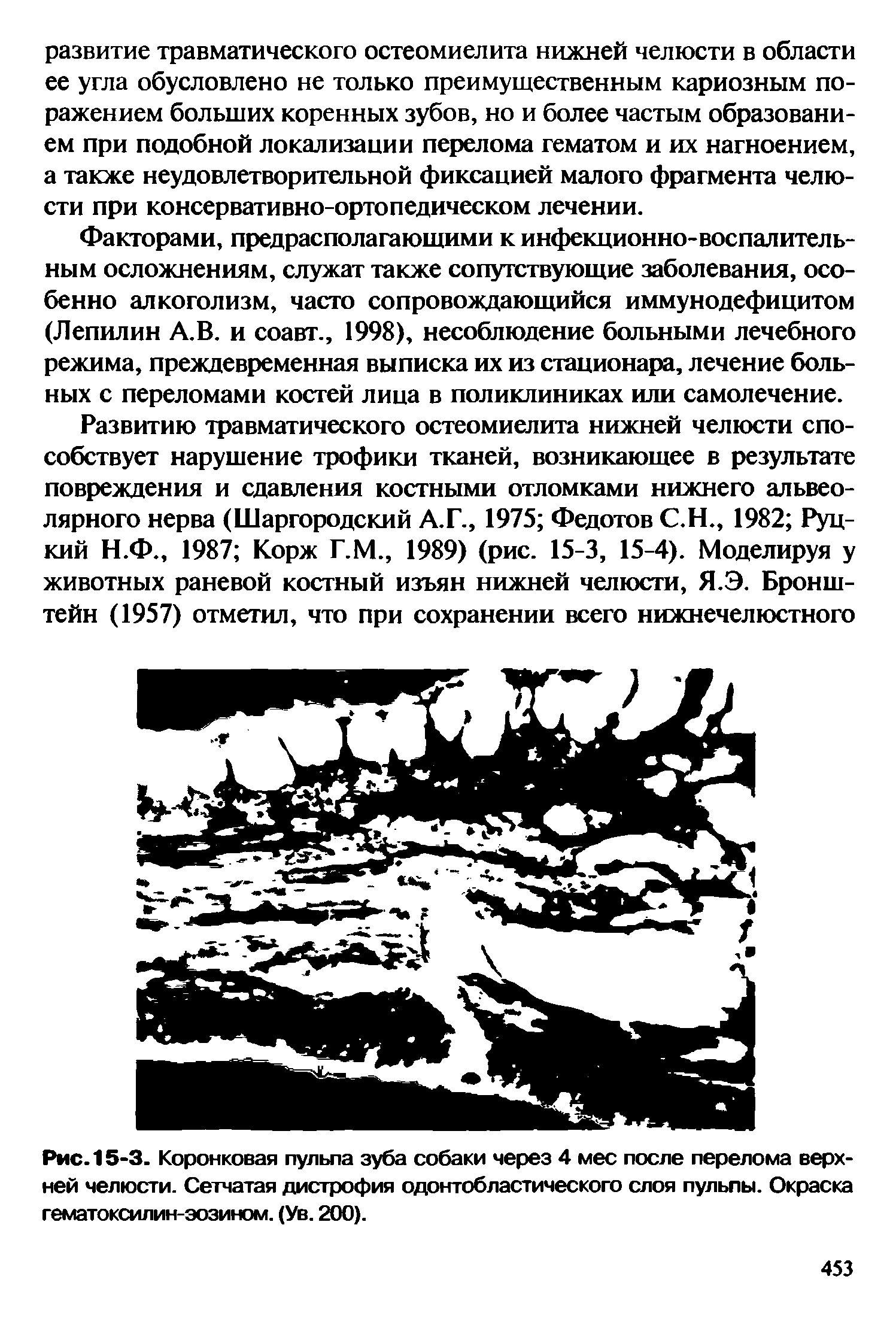 Рис. 15-3. Коронковая пульпа зуба собаки через 4 мес после перелома верхней челюсти. Сетчатая дистрофия одонтобластического слоя пульпы. Окраска гематоксилин-эозином. (Ув. 200).