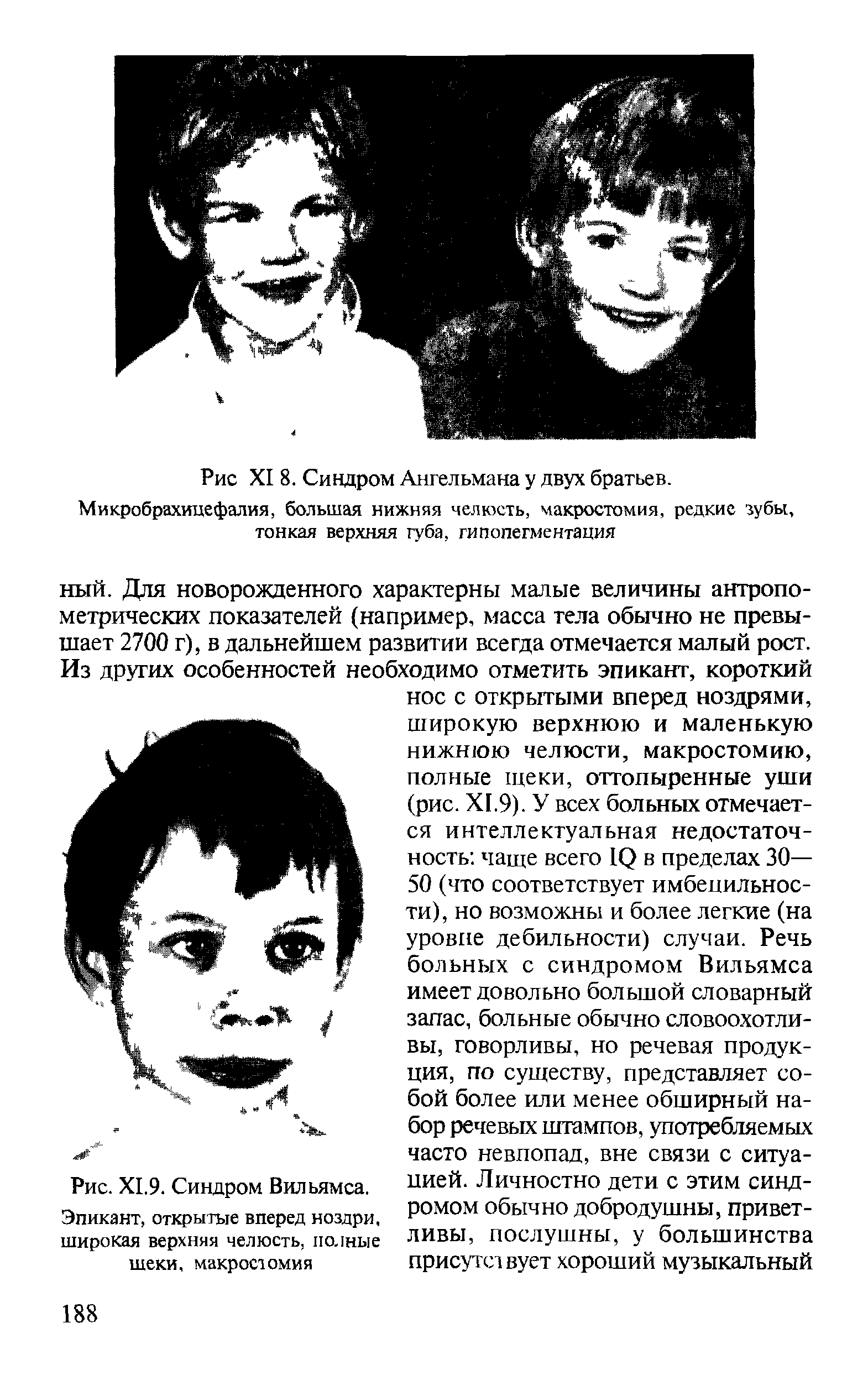 Рис. Х1.9. Синдром Вильямса. Эпикант, открытые вперед ноздри, широкая верхняя челюсть, полные шеки, макростомия...