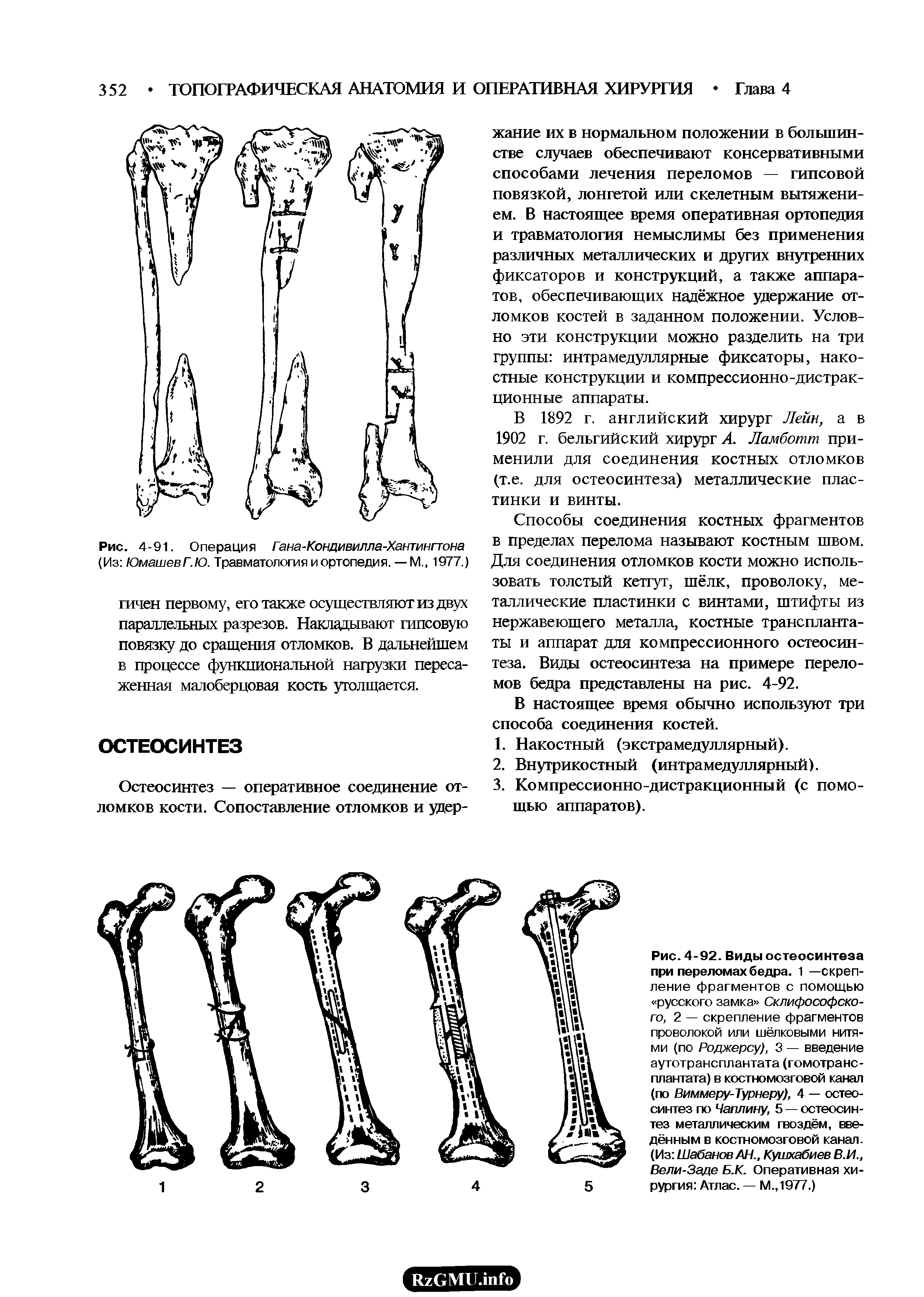 Рис. 4-91. Операция Гана-Кондивилла-Хантингтона (Из ЮмашевГ.Ю. Травматология и ортопедия. — М., 1977.)...