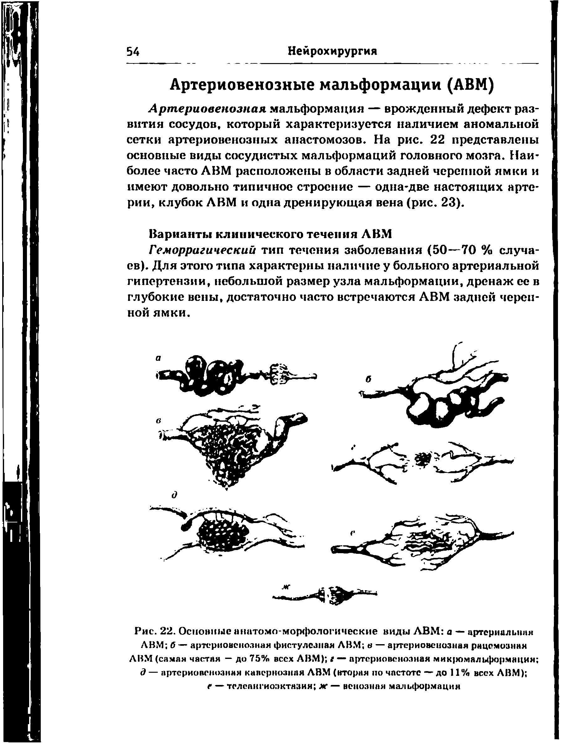 Рис. 22. Основные анатомо-морфологические виды ЛВМ а — артериальная ЛВМ б— артериовенозная фистулезная ЛВМ к — артериовенозная рацемозная ЛВМ (самая частая — до 75% всех ЛВМ) I — артериовенозная мик юмальформация д — артериовенозная кавернозная ЛВМ (вторая по частоте — до 11% всех ЛВМ) г — телспигиозктазия ж — венозная мальформация...