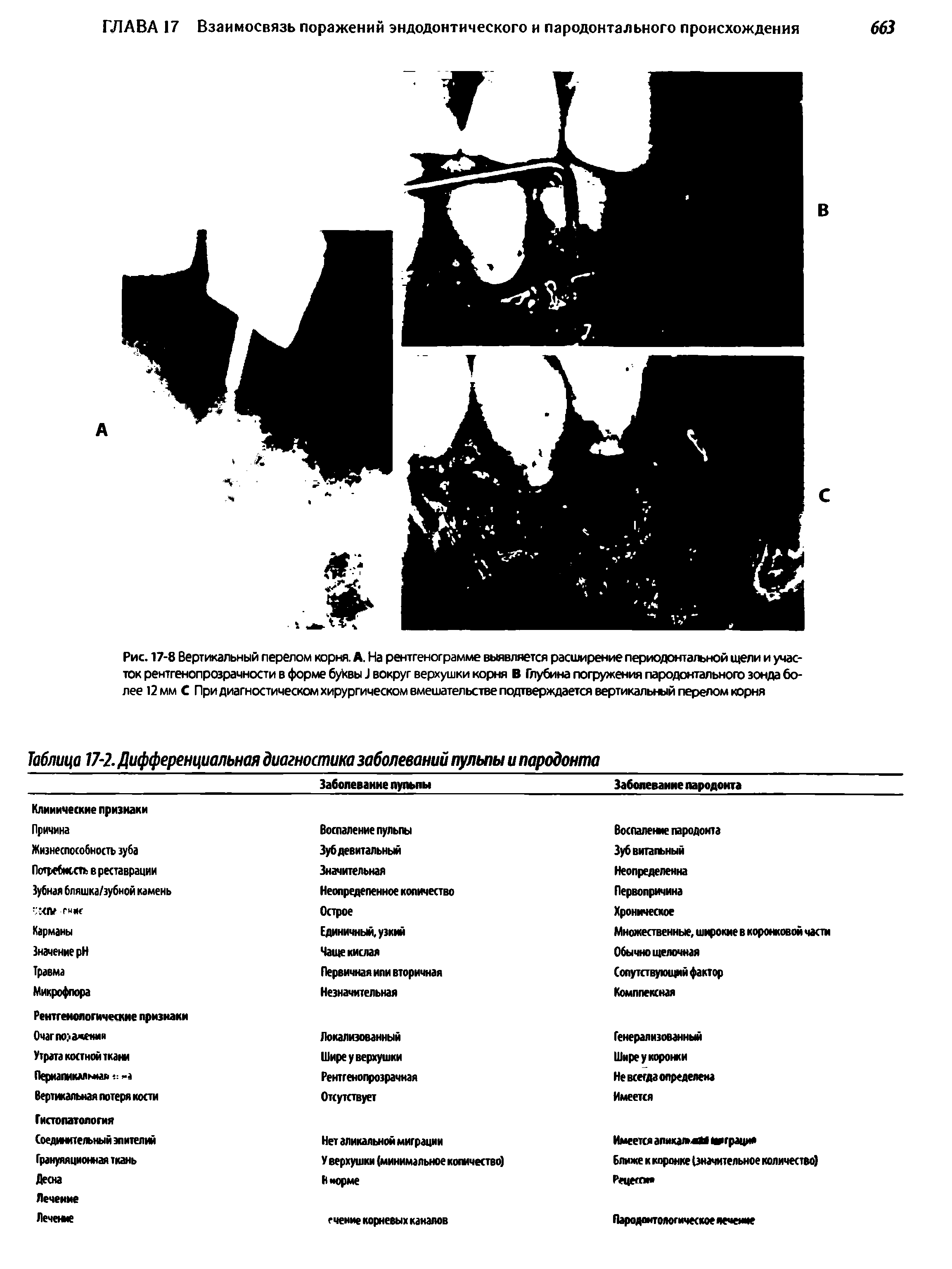 Таблица 17-2. Дифференциальная диагностика заболеваний пульпы и пародонта...