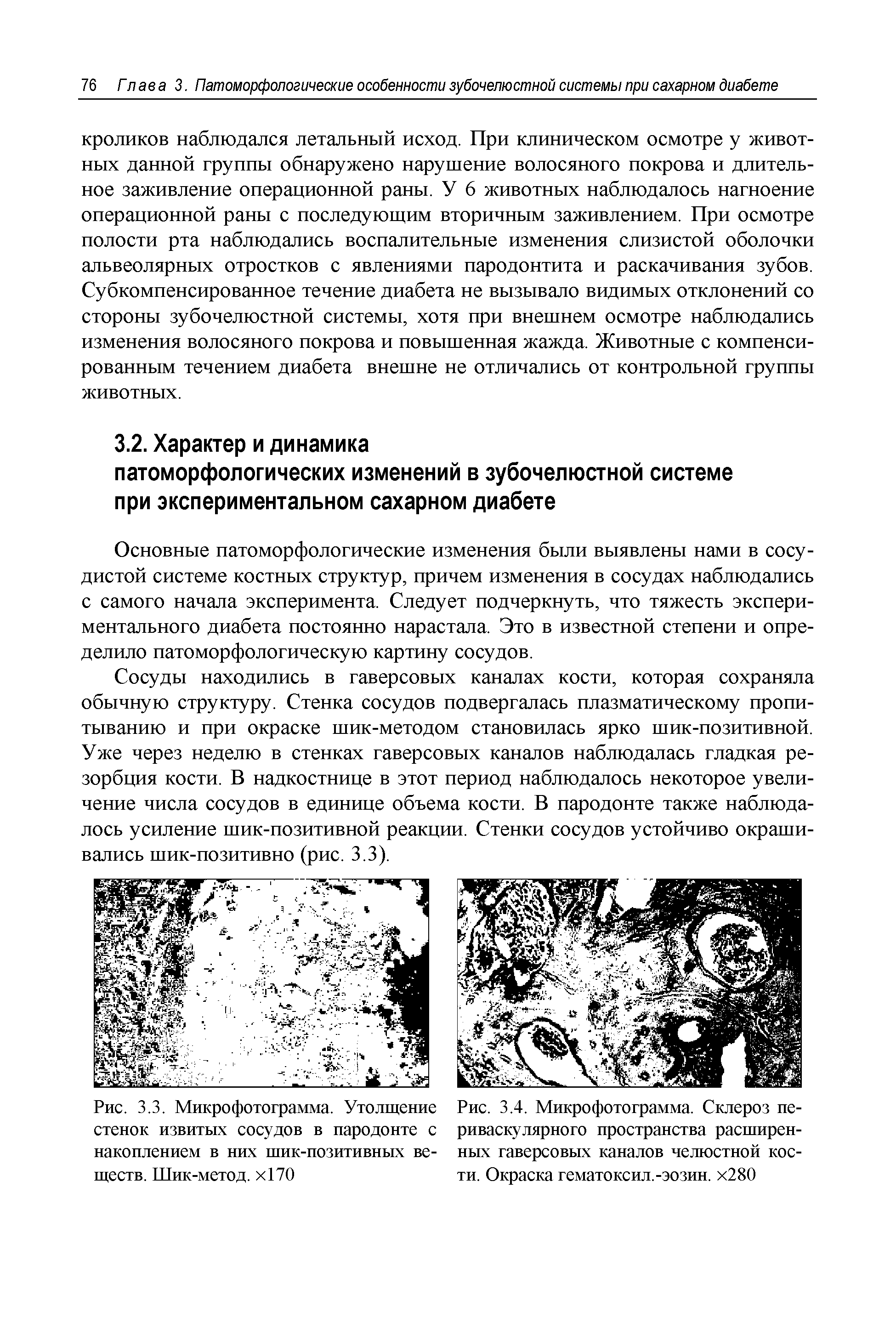 Рис. 3.4. Микрофотограмма. Склероз периваскулярного пространства расширенных гаверсовых каналов челюстной кости. Окраска гематоксил.-эозин. х280...