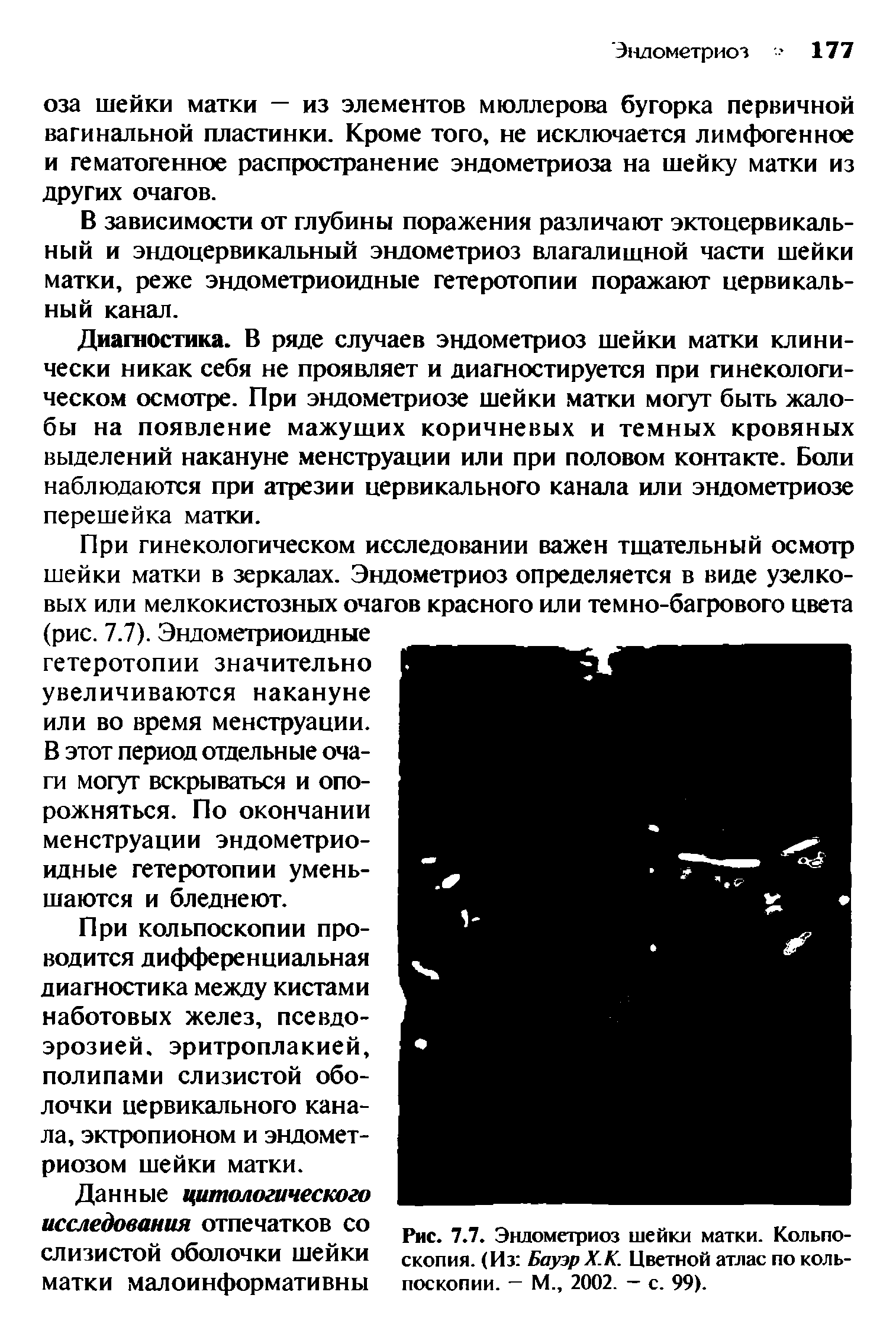 Рис. 7.7. Эндометриоз шейки матки. Кольпоскопия. (Из Бауэр Х.К. Цветной атлас по кольпоскопии. — М., 2002. — с. 99).