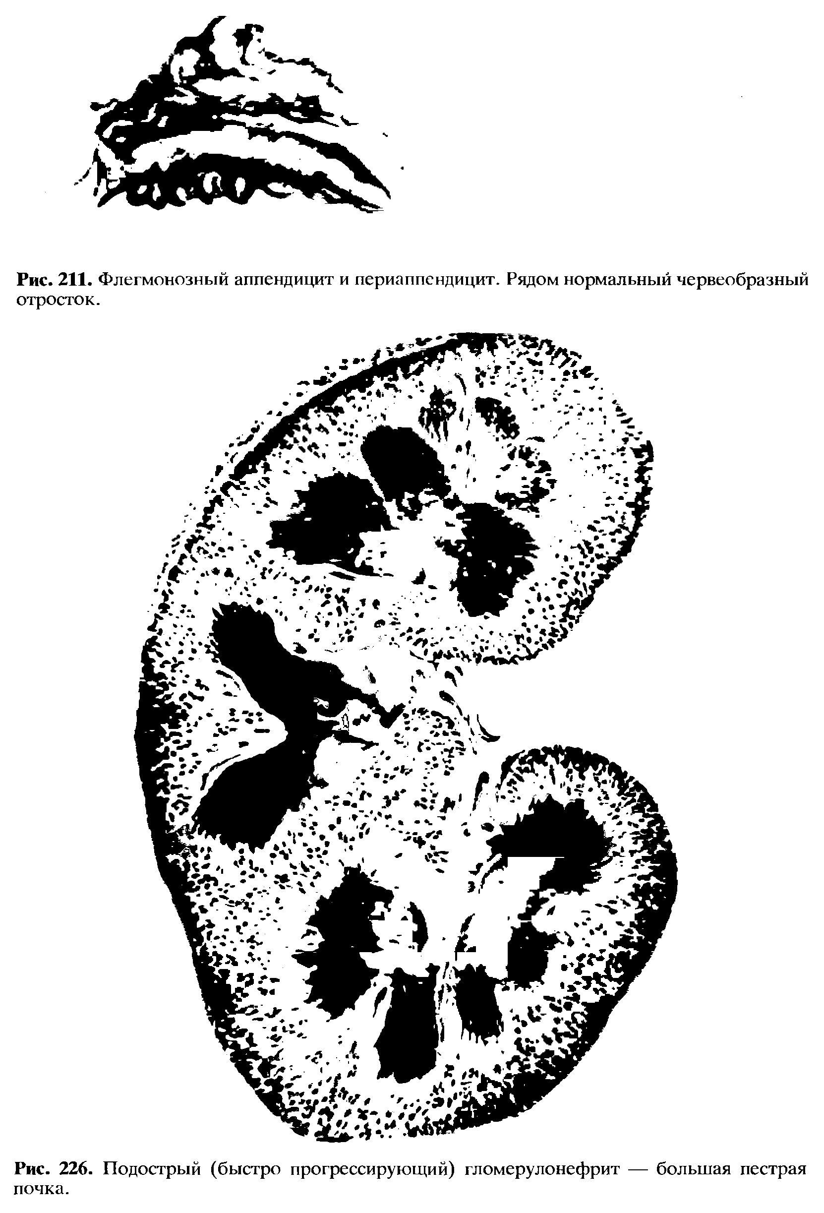 Рис. 226. Подострый (быстро прогрессирующий) гломерулонефрит — большая пестрая почка.