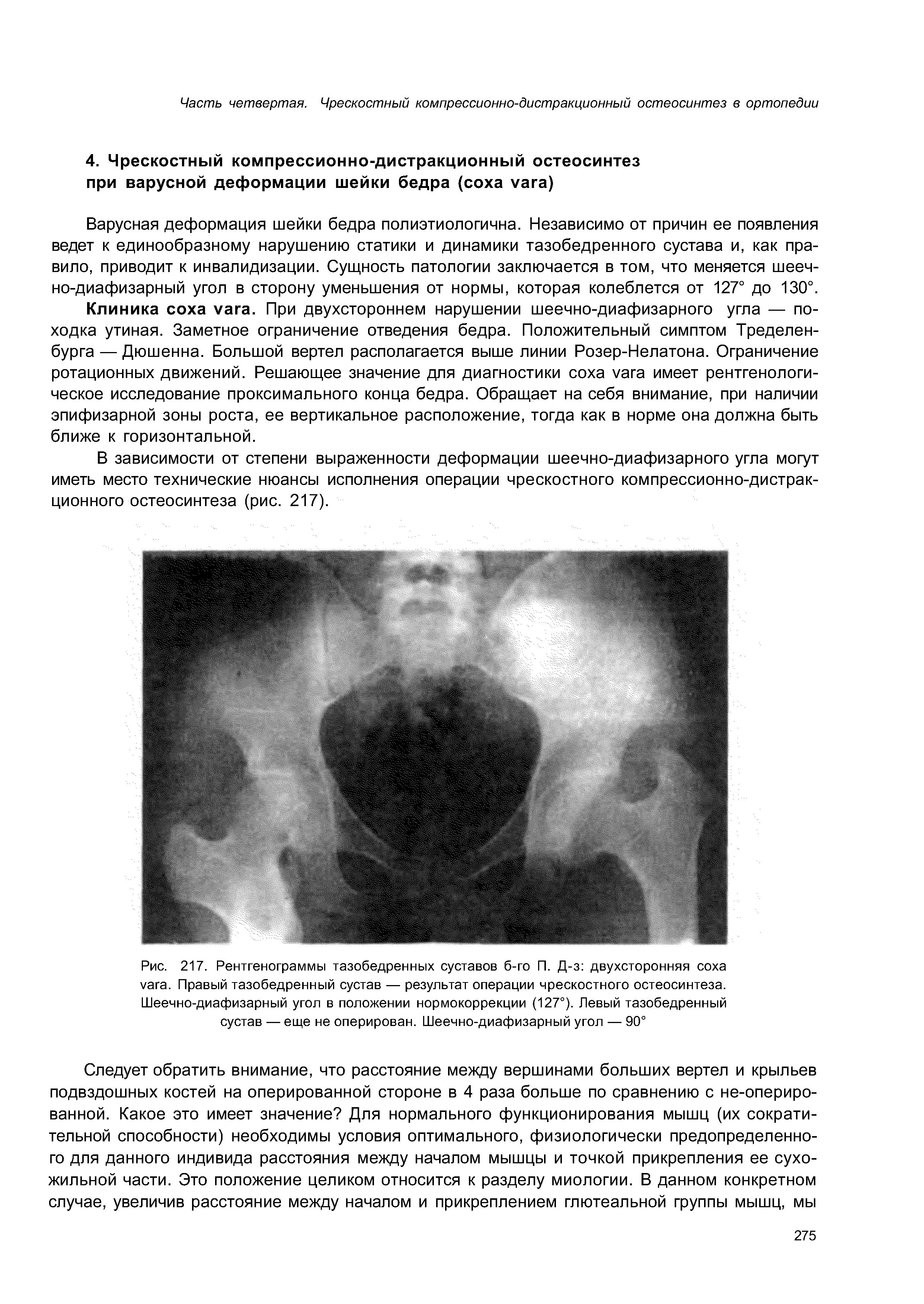 Рис. 217. Рентгенограммы тазобедренных суставов б-го П. Д-з двухсторонняя соха . Правый тазобедренный сустав — результат операции чрескостного остеосинтеза. Шеечно-диафизарный угол в положении нормокоррекции (127°). Левый тазобедренный сустав — еще не оперирован. Шеечно-диафизарный угол — 90°...
