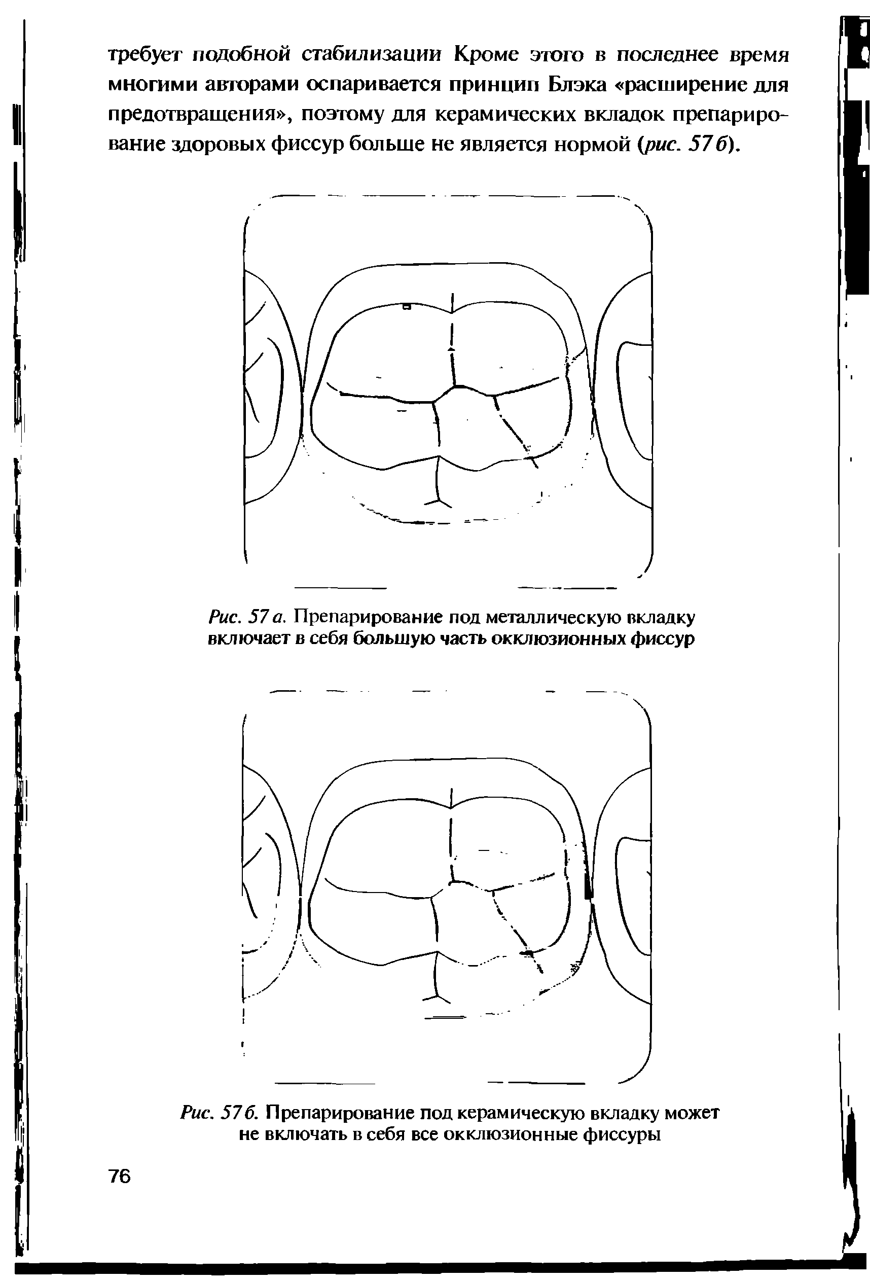 Рис. 576. Препарирование под керамическую вкладку может не включать в себя все окклюзионные фиссуры...