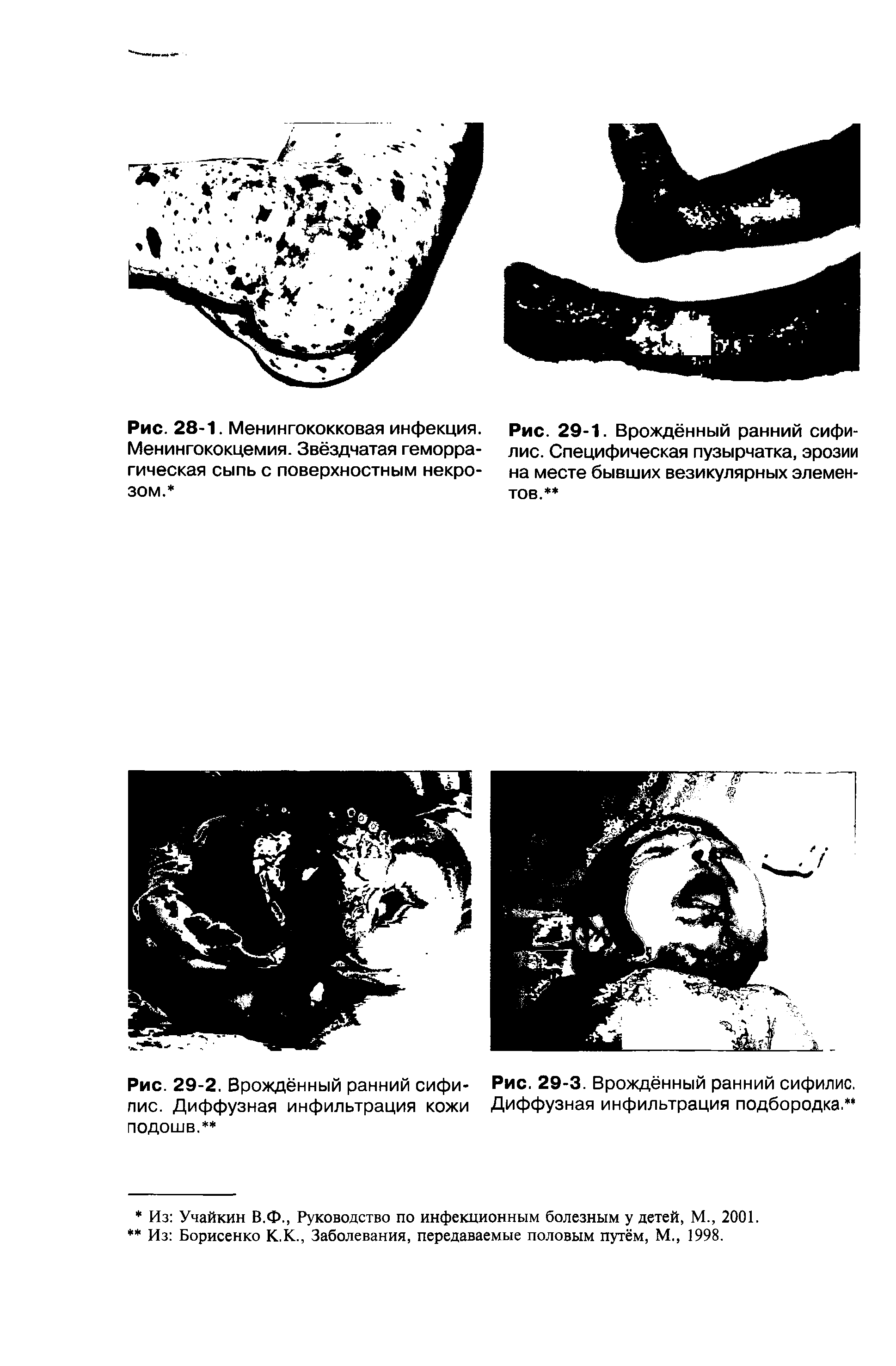 Рис. 29-1. Врождённый ранний сифилис. Специфическая пузырчатка, эрозии на месте бывших везикулярных элементов. ...