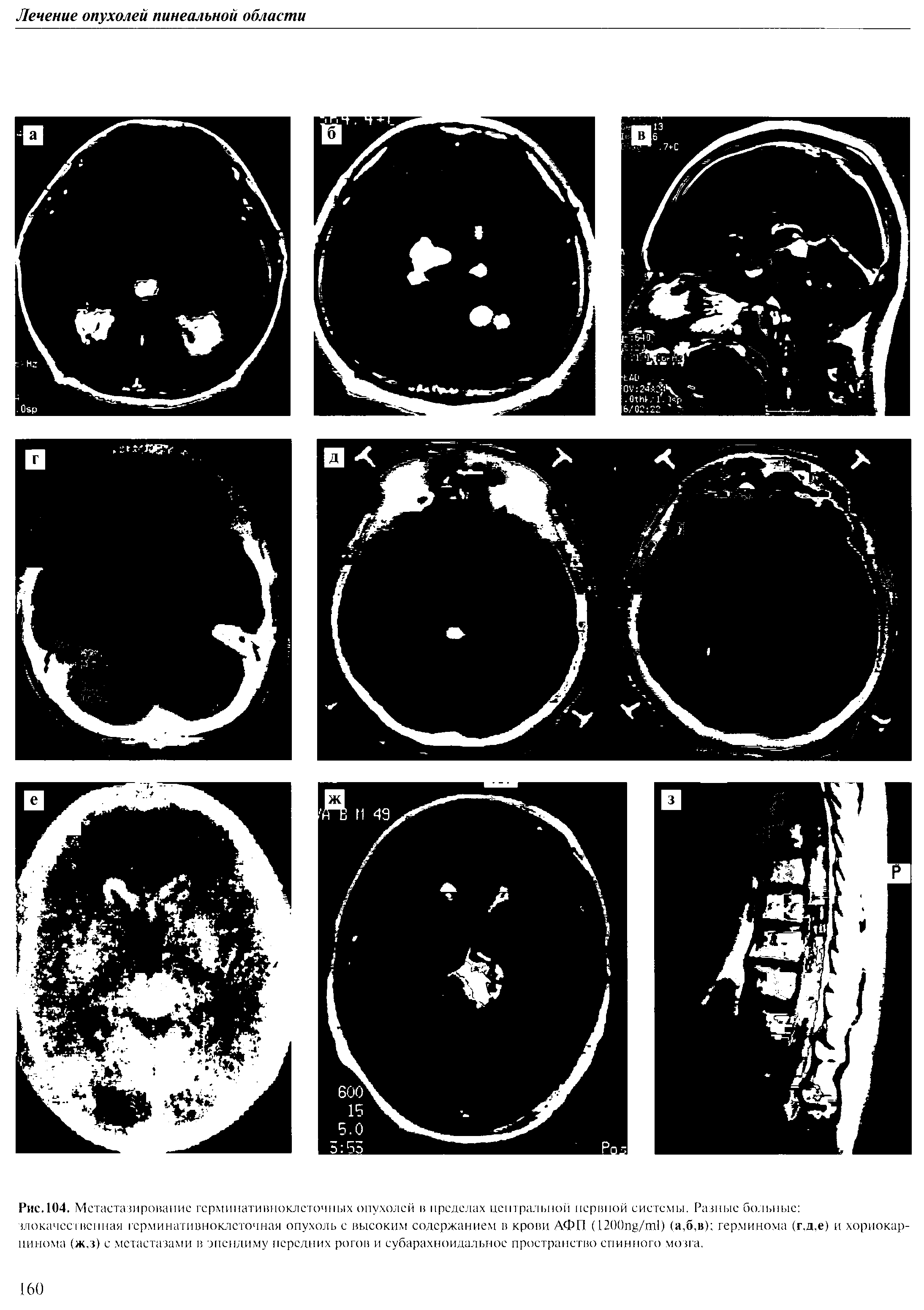 Рис. 104. Метастазирование гсрминативноклсточпых опухолей в пределах центральной нервной системы. Разные больные злокачественная герминатнвноклеточная опухоль с высоким содержанием в крови АФП (1200пв/т1) (а,б,в) герминома (г.д.е) и хориокарцинома (ж.з) с метастазами в эпендиму передних рогов и субарахноидальное пространство спинного мозга.
