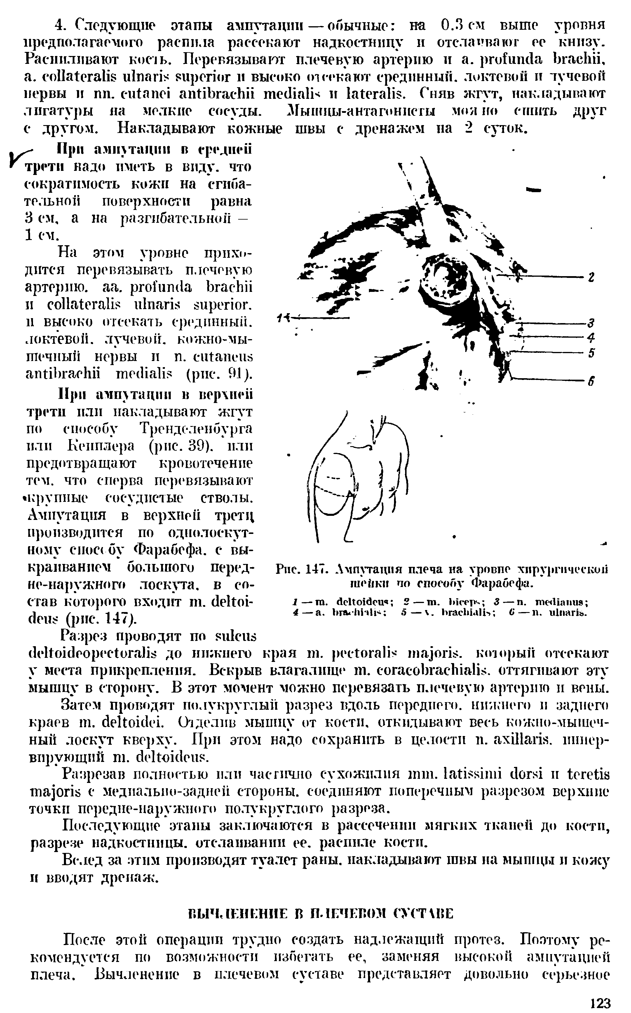 Рис. 147. Ампутация плеча на уровпе хирургической шейки по способу Фарабефа.