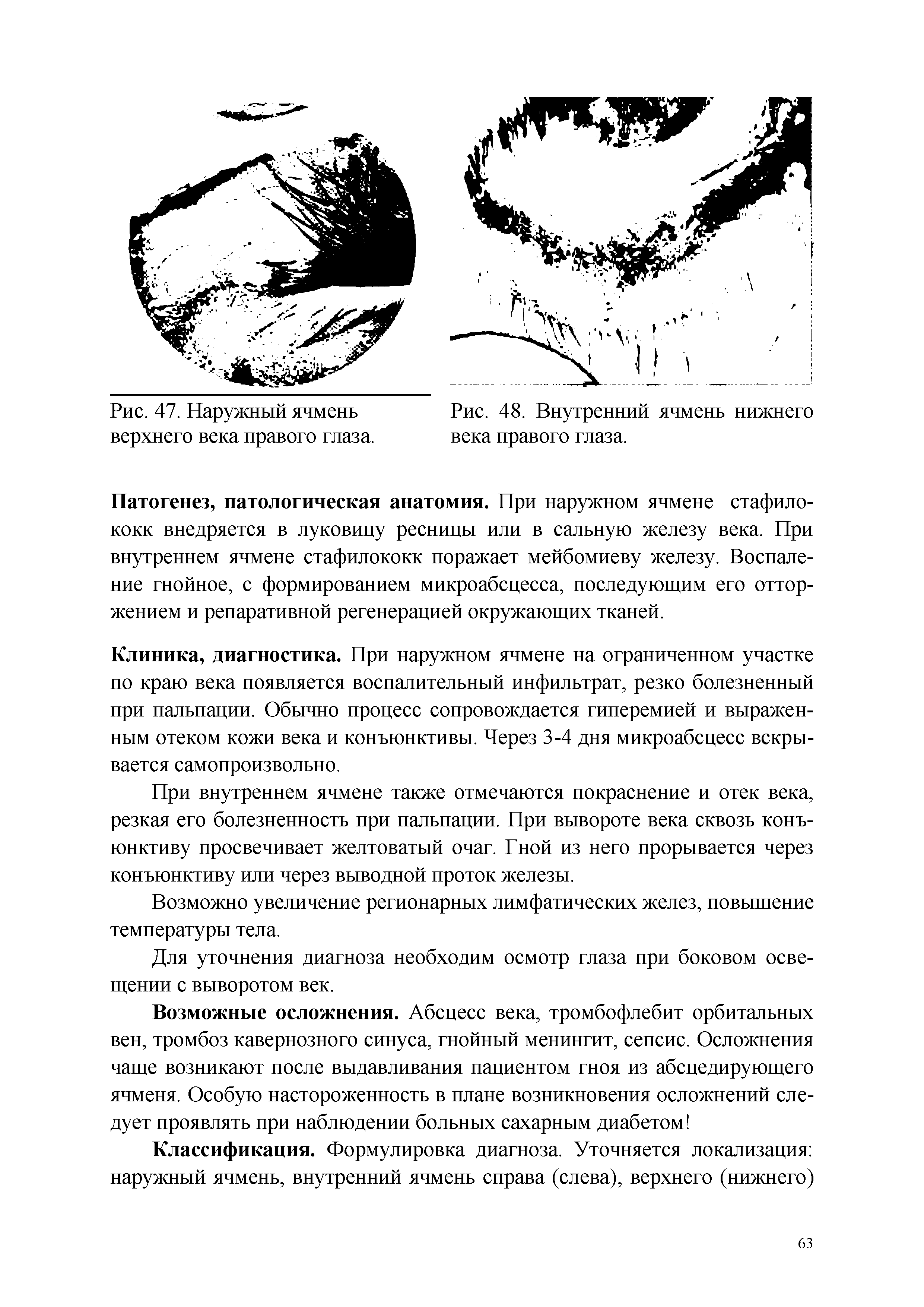 Рис. 48. Внутренний ячмень нижнего века правого глаза.