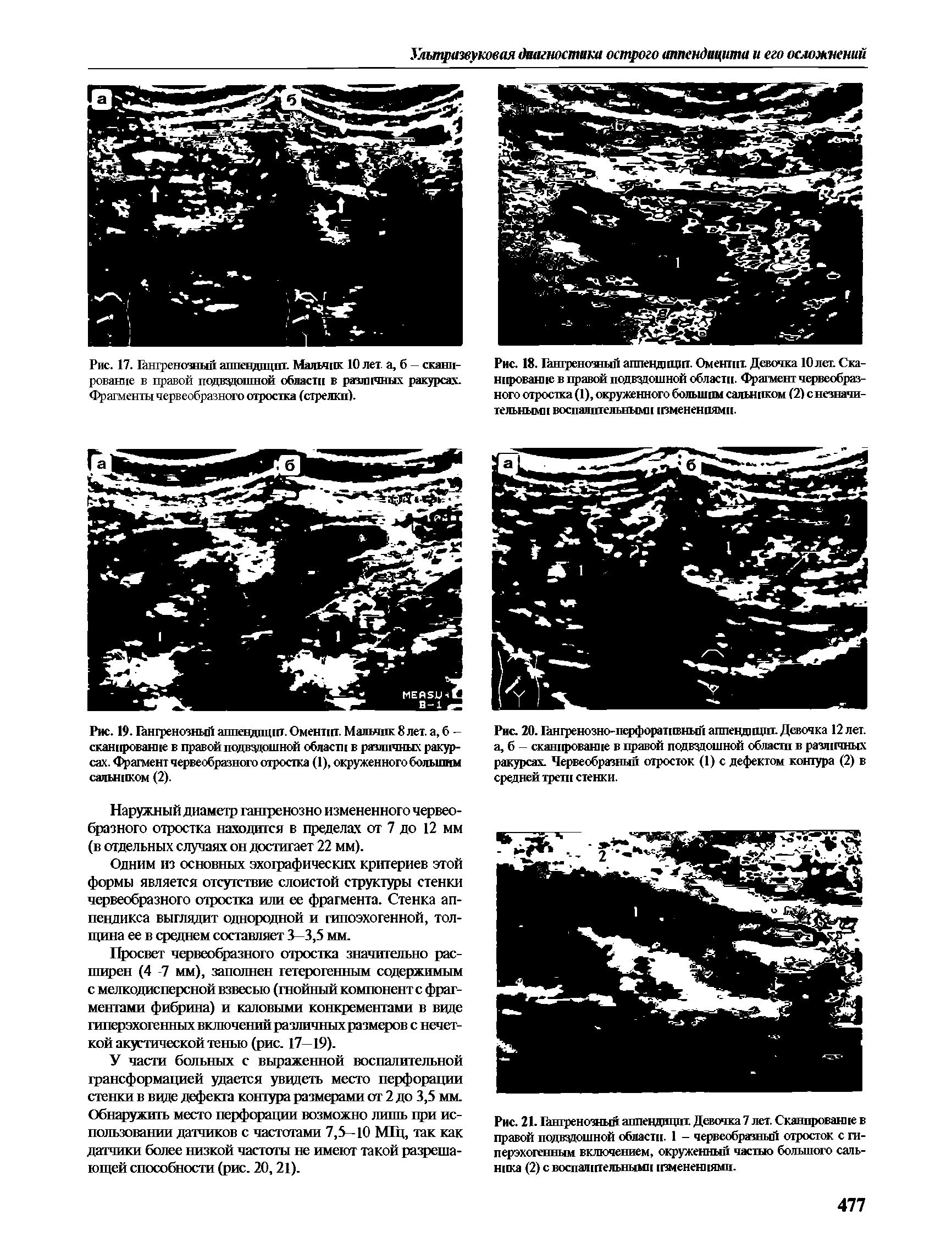 Рис. 20. Гангренозно-перфоративный аппендицит. Девочка 12 лет. а, б — сканирование в правой подвздошной области в различных ракурсах. Червеобразный отросток (1) с дефектам контура (2) в средней трети стенки.