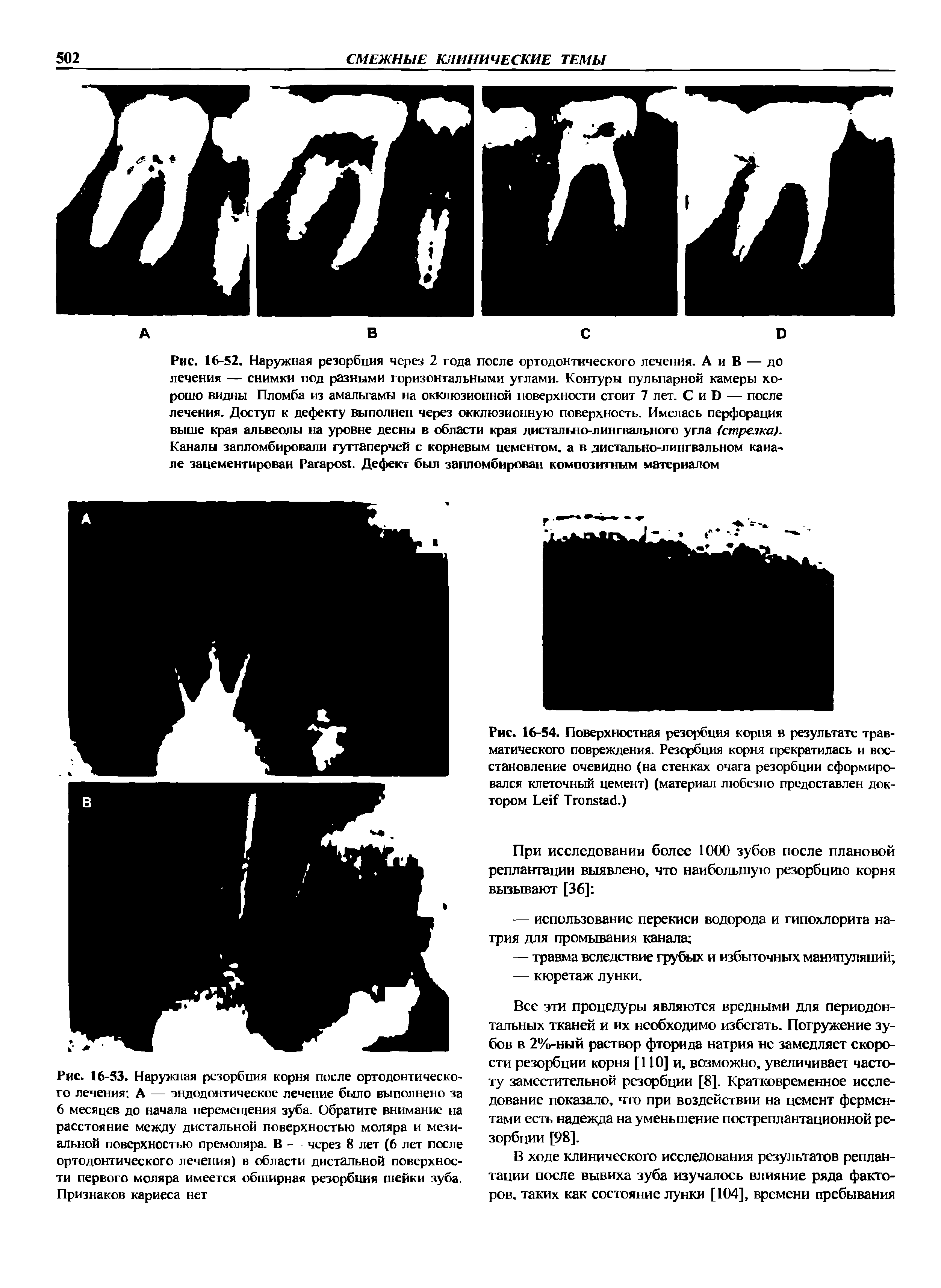 Рис. 16-54. Поверхностная резорбция корня в результате травматического повреждения. Резорбция корня прекратилась и восстановление очевидно (на стенках очага резорбции сформировался клеточный цемент) (материал любезно предоставлен доктором L T .)...