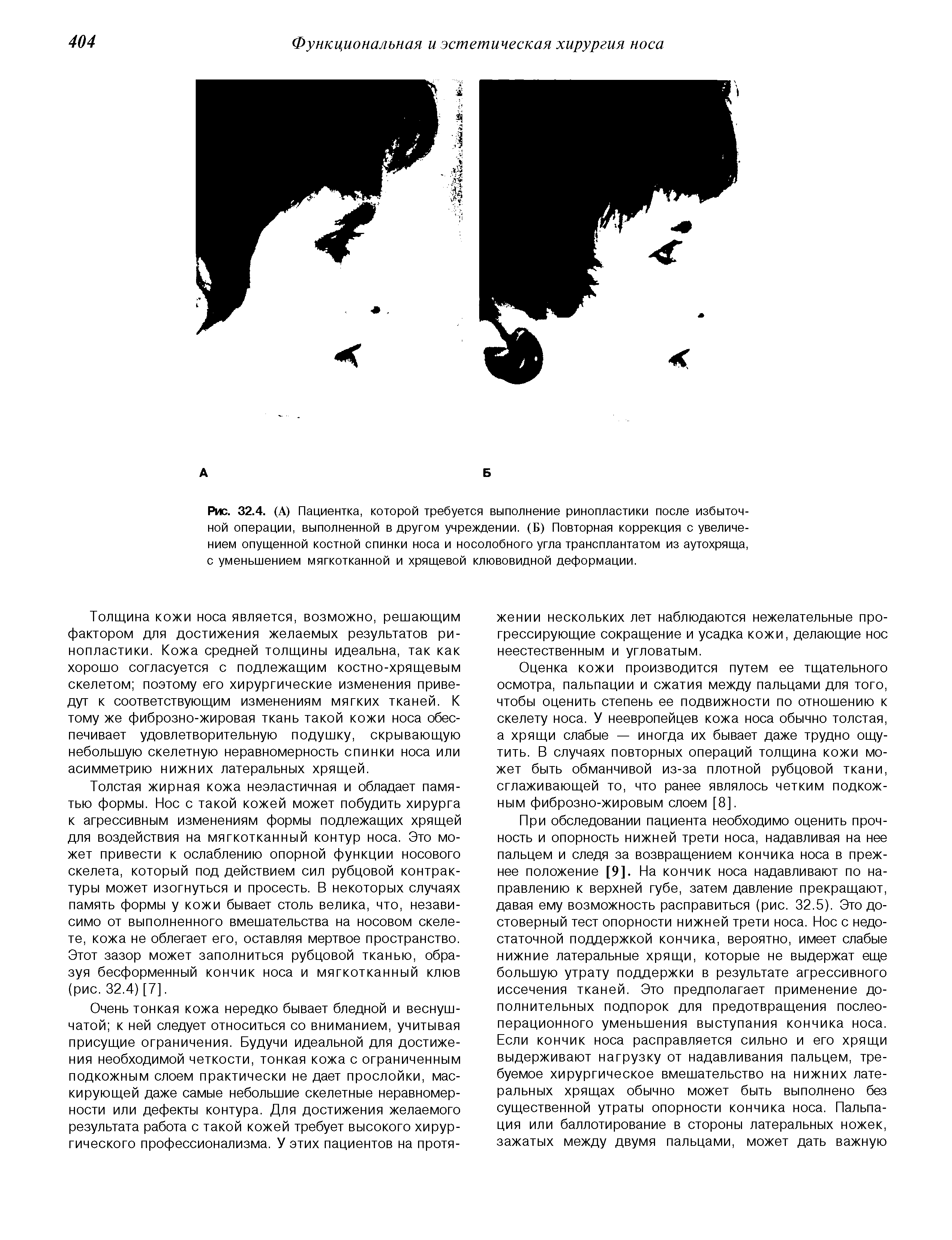 Рис. 32.4. (А) Пациентка, которой требуется выполнение ринопластики после избыточной операции, выполненной в другом учреждении. (Б) Повторная коррекция с увеличением опущенной костной спинки носа и носолобного угла трансплантатом из аутохряща, с уменьшением мягкотканной и хрящевой клювовидной деформации.