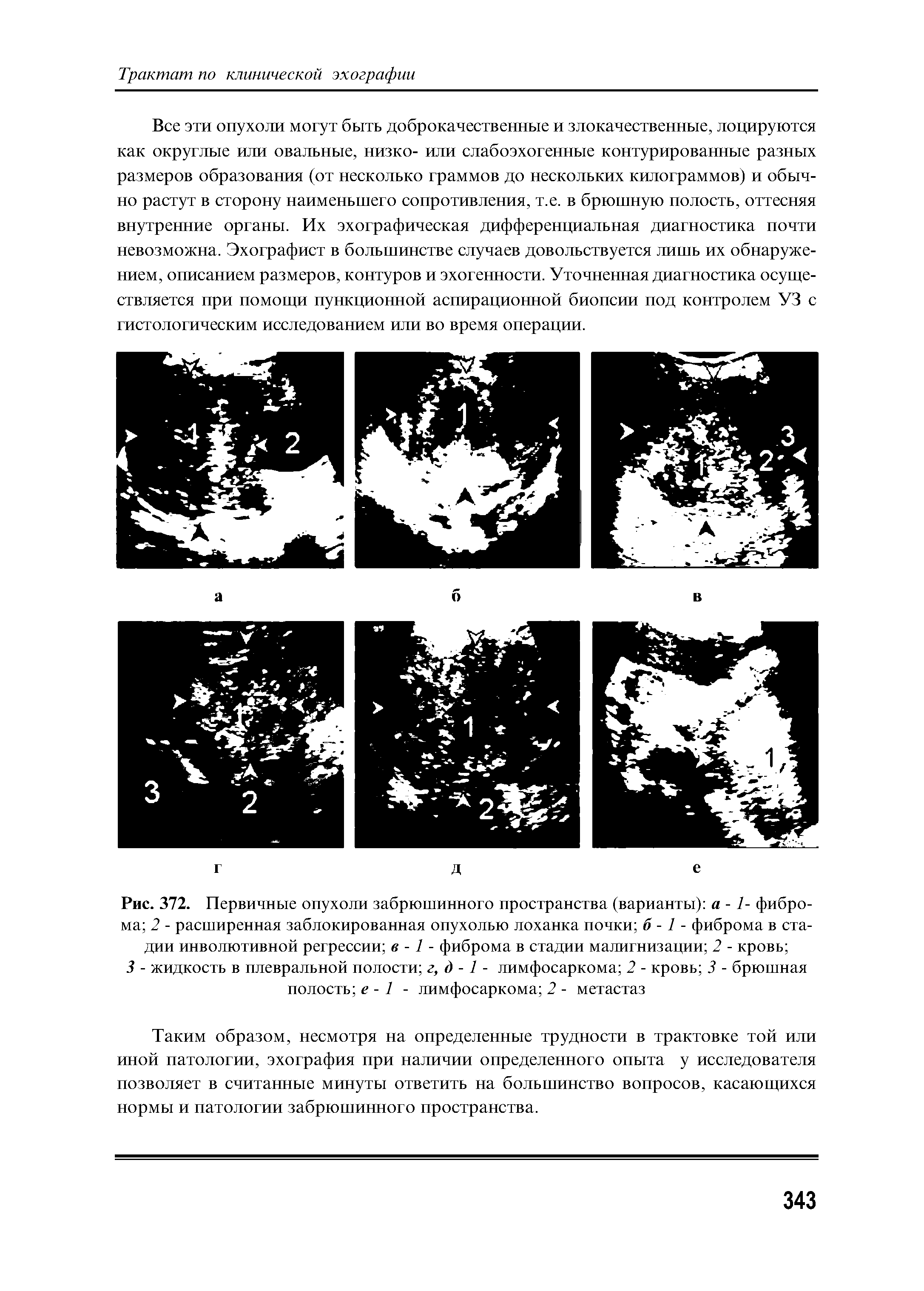 Рис. 372. Первичные опухоли забрюшинного пространства (варианты) а -1- фиброма 2 - расширенная заблокированная опухолью лоханка почки б -1 - фиброма в стадии инволютивной регрессии в -1 - фиброма в стадии малигнизации 2 - кровь ...