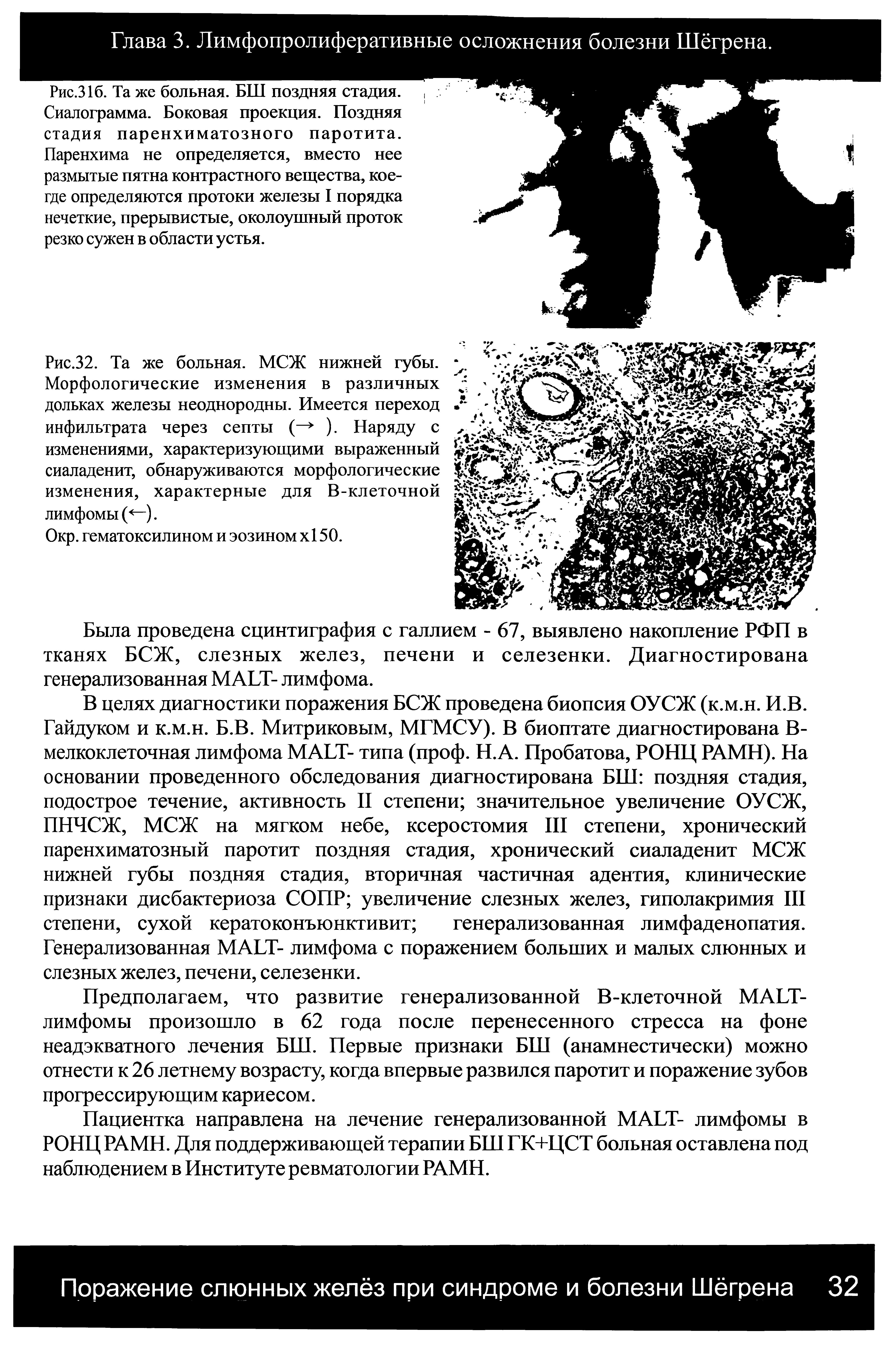 Рис.32. Та же больная. МСЖ нижней губы. Морфологические изменения в различных дольках железы неоднородны. Имеется переход инфильтрата через септы (— ). Наряду с изменениями, характеризующими выраженный сиаладенит, обнаруживаются морфологические изменения, характерные для В-клеточной лимфомы (<—).