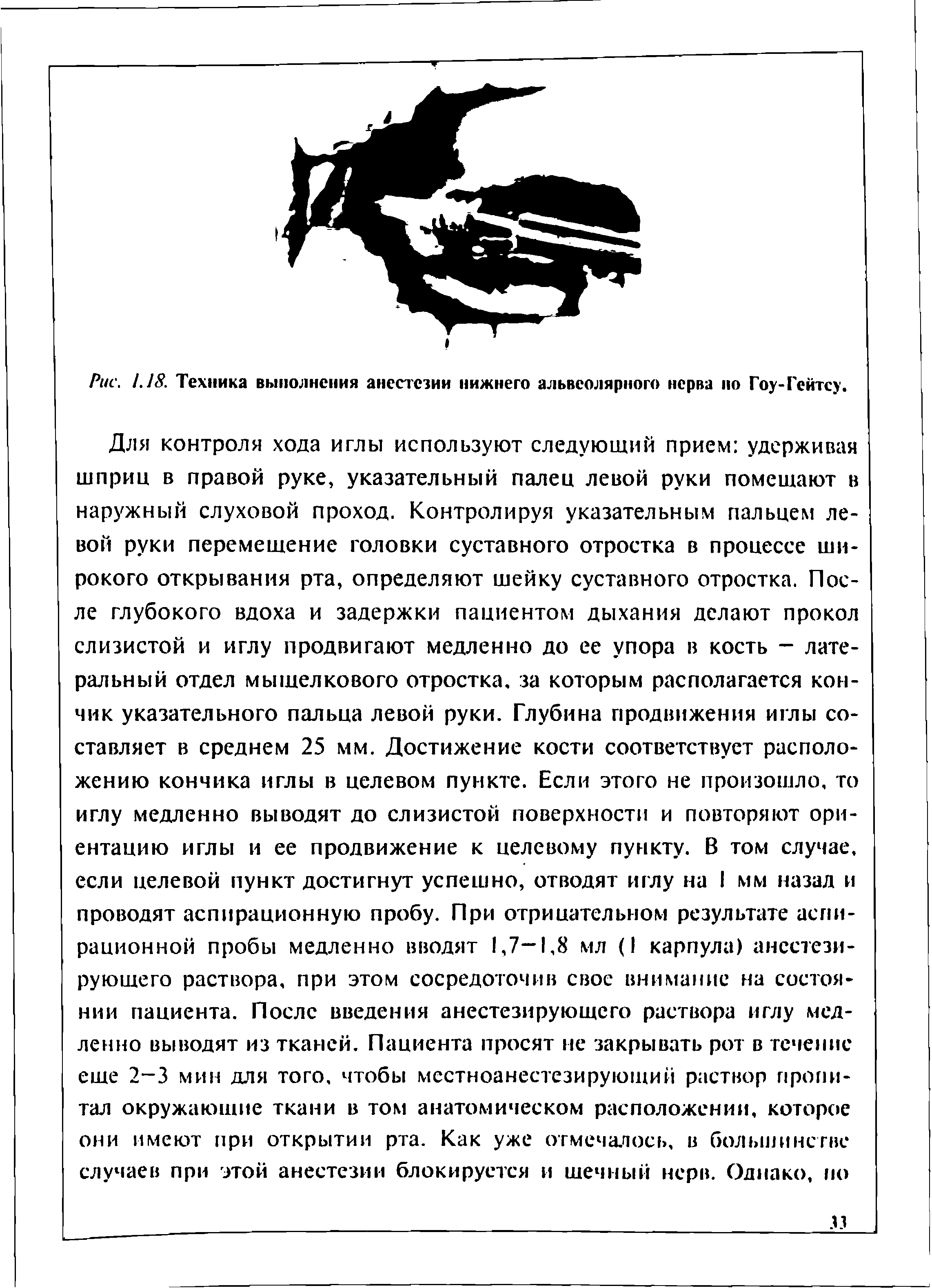 Рис. 1.18. Техника выполнения анестезии нижнего альвеолярного нерва по Гоу-Гейтсу.