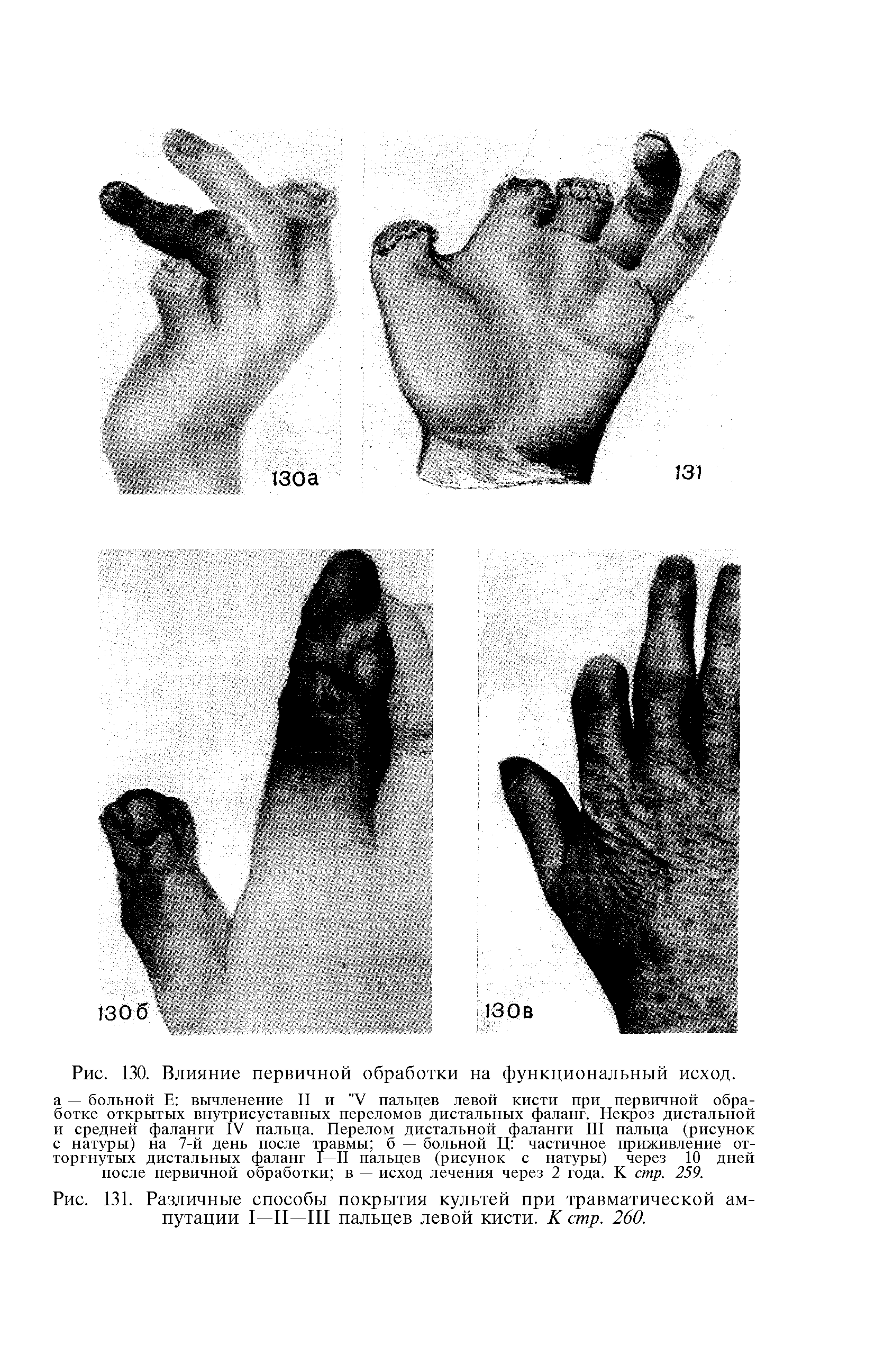 Рис. 131. Различные способы покрытия культей при травматической ампутации I—II—III пальцев левой кисти. К стр. 260.