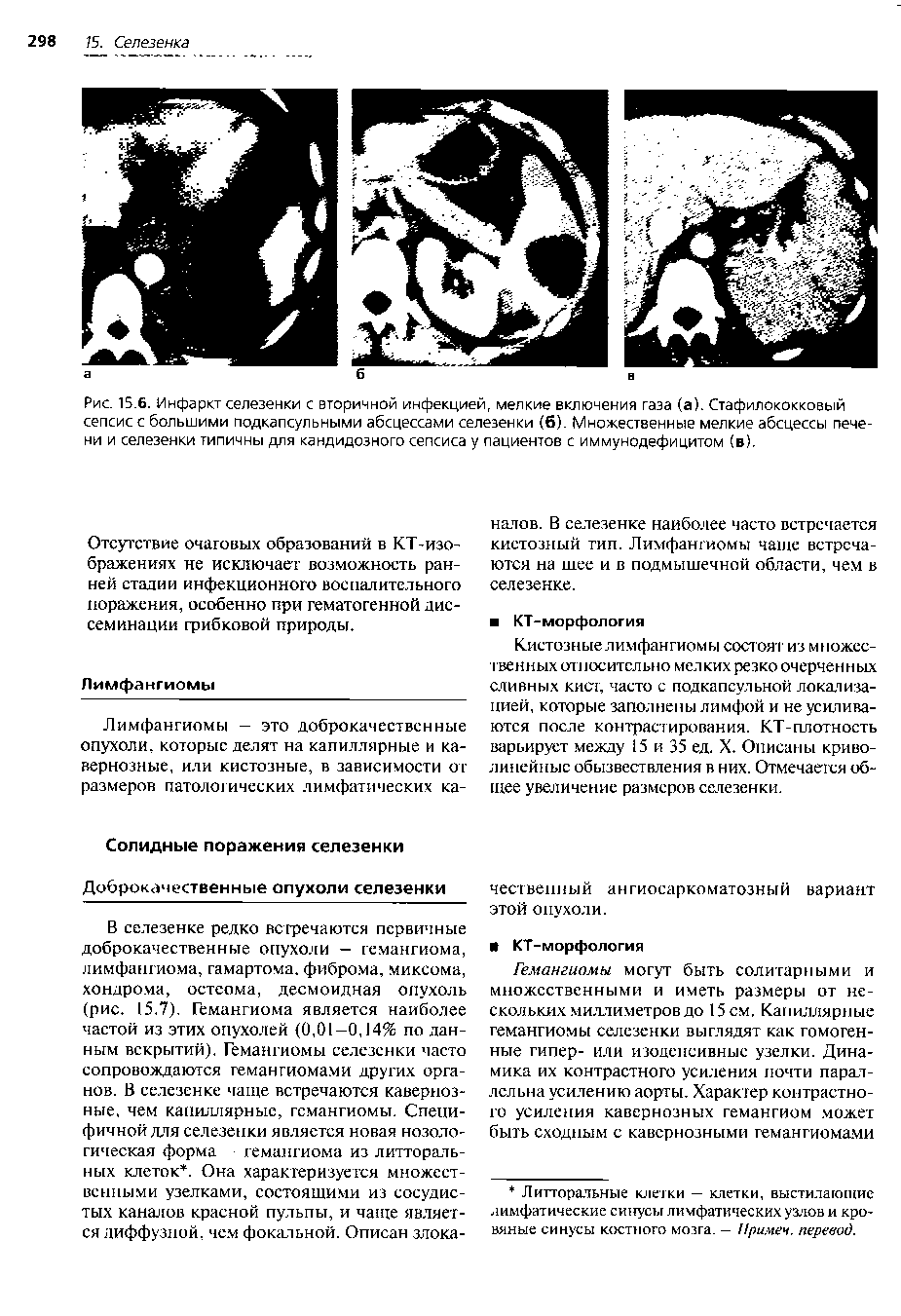 Рис. 15.6. Инфаркт селезенки с вторичной инфекцией, мелкие включения газа (а). Стафилококковый сепсис с большими подкапсульными абсцессами селезенки (6). Множественные мелкие абсцессы печени и селезенки типичны для кандидозного сепсиса у пациентов с иммунодефицитом (в).