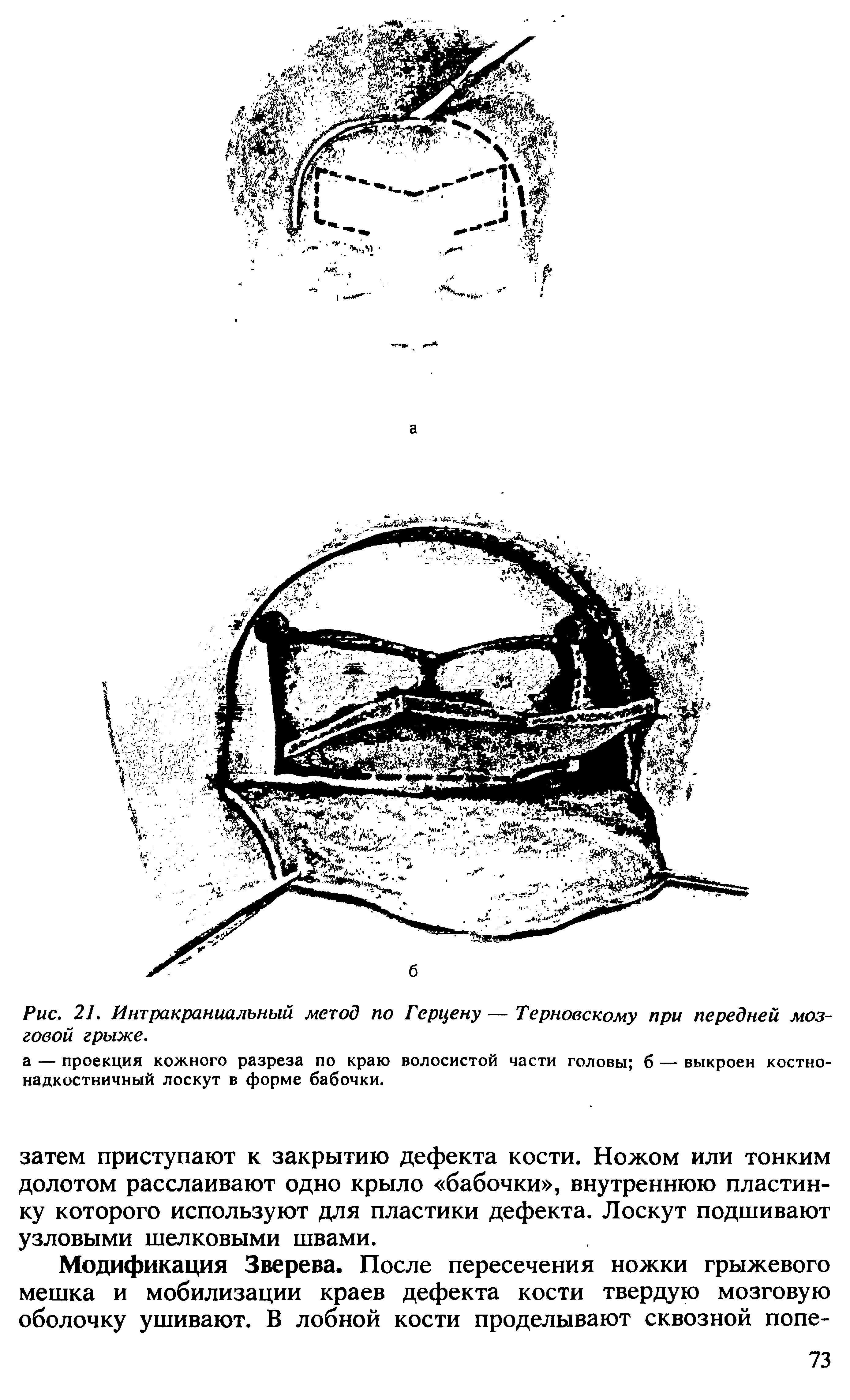 Рис. 21. Интракраниальный метод по Герцену — Терновскому при передней мозговой грыже.