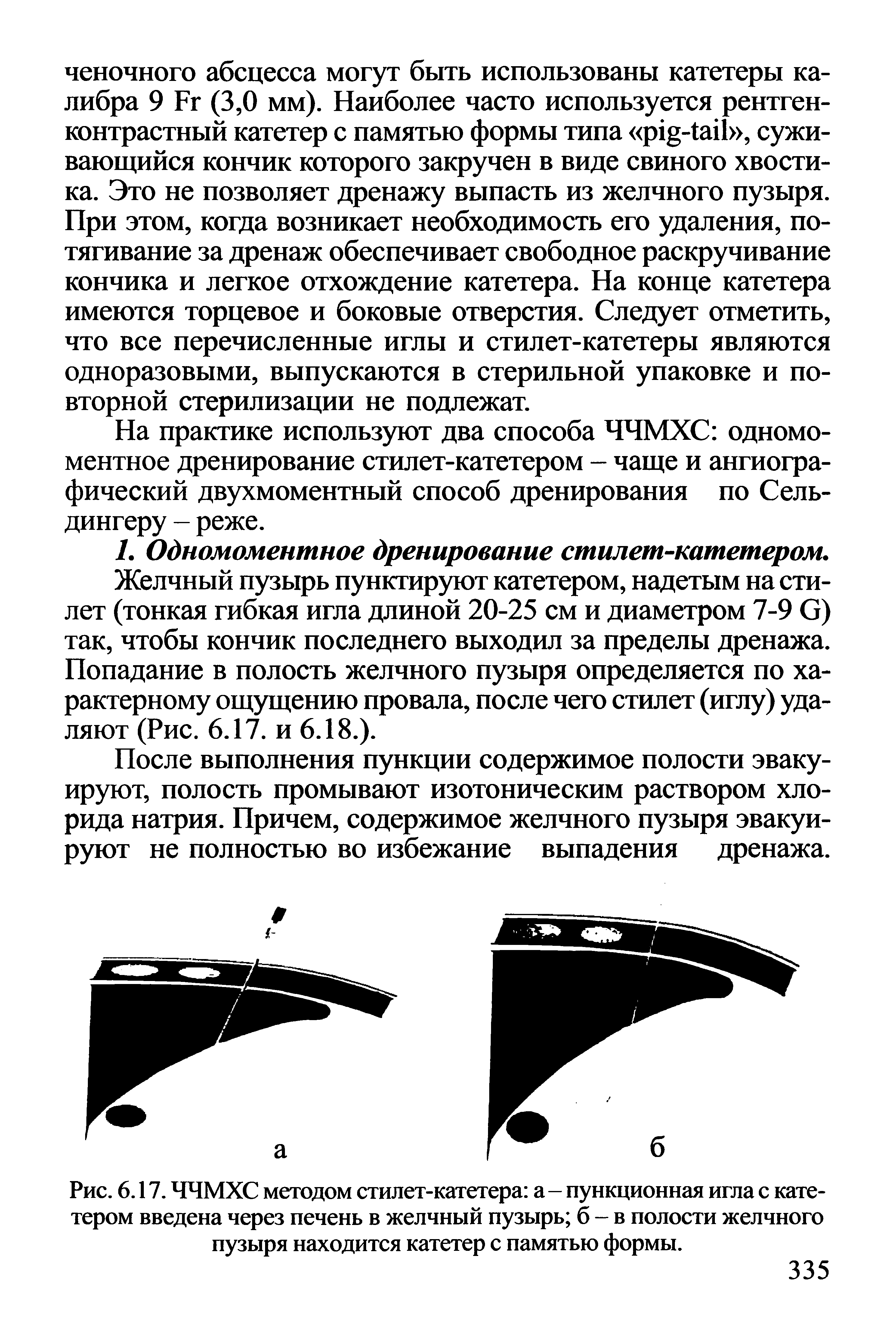 Рис. 6.17. ЧЧМХС методом стилет-катетера а - пункционная игла с катетером введена через печень в желчный пузырь б - в полости желчного пузыря находится катетер с памятью формы.