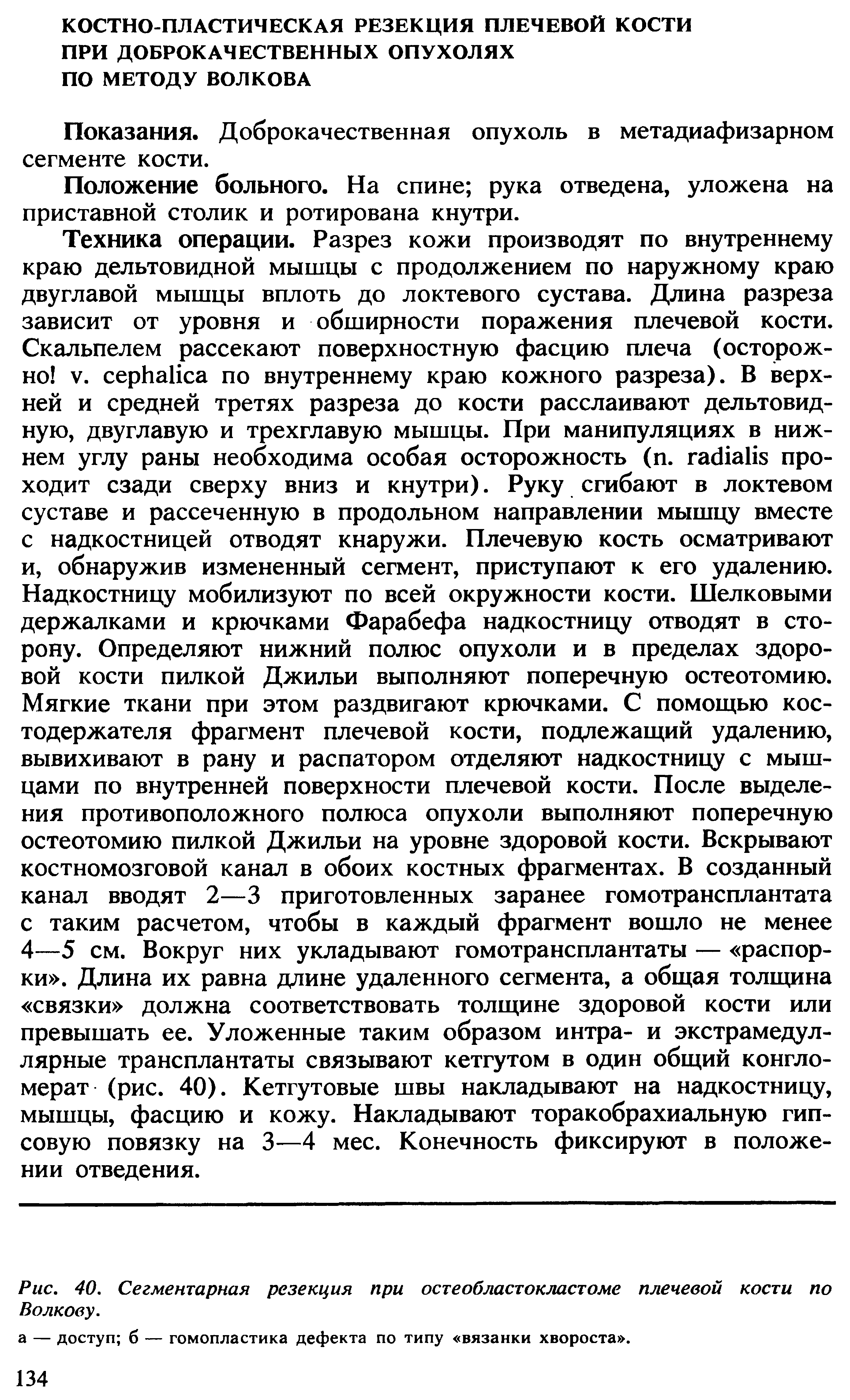 Рис. 40. Сегментарная резекция при остеобластокластоме плечевой кости по Волкову.