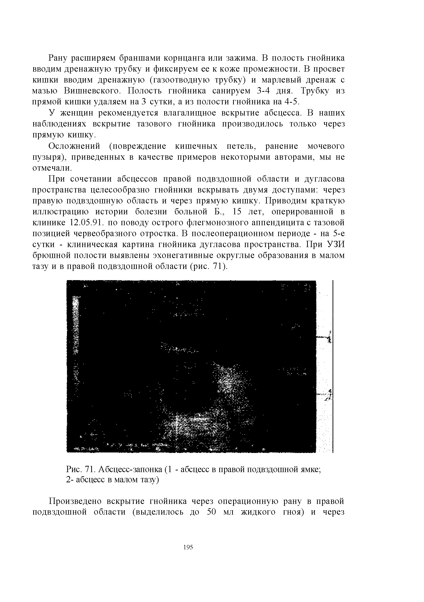 Рис. 71. Абсцесс-запонка (1 - абсцесс в правой подвздошной ямке 2- абсцесс в малом тазу)...