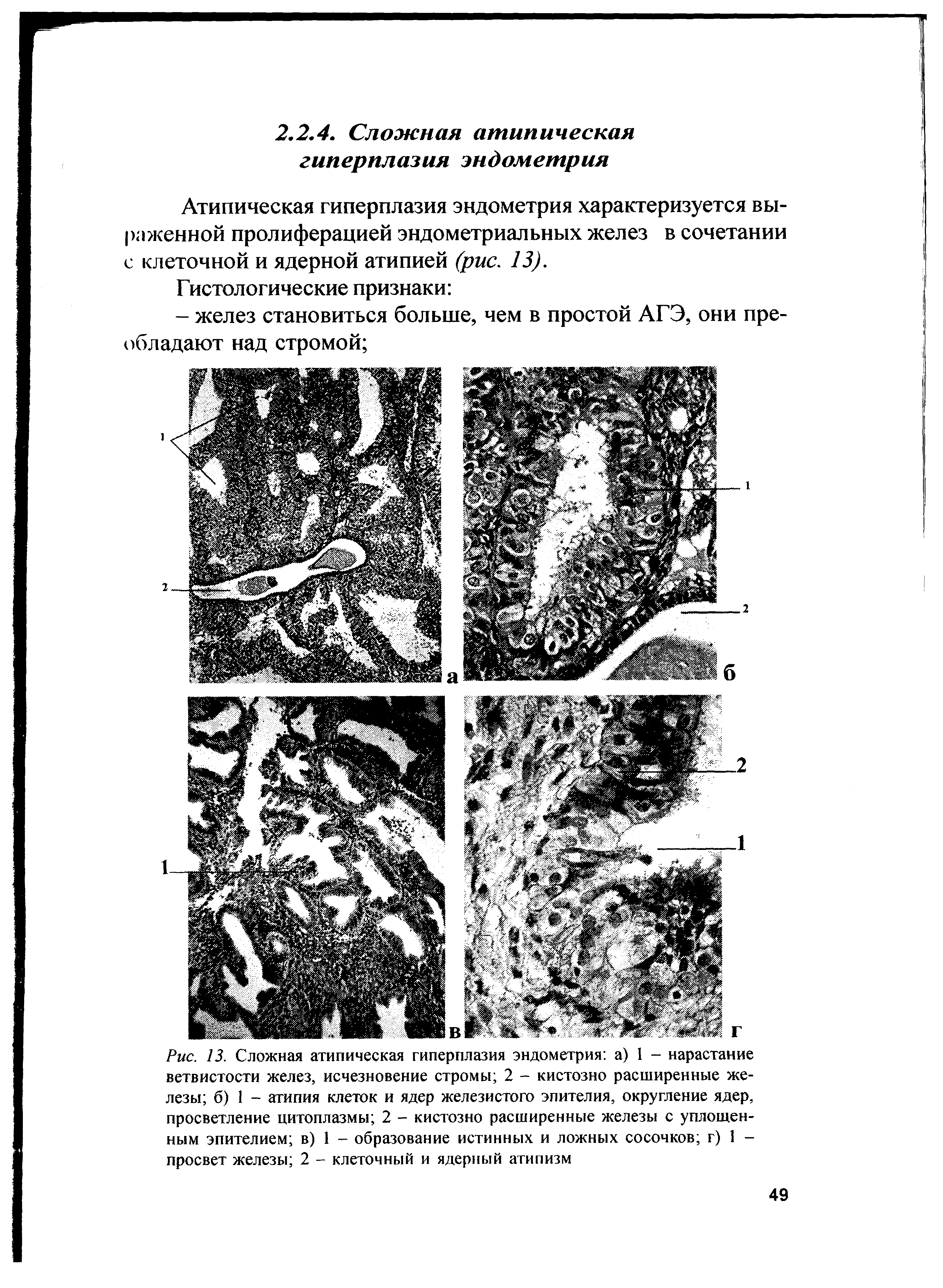 Рис. 13. Сложная атипическая гиперплазия эндометрия а) 1 - нарастание ветвистости желез, исчезновение стромы 2 - кистозно расширенные железы б) 1 - атипия клеток и ядер железистого эпителия, округление ядер, просветление цитоплазмы 2 - кистозно расширенные железы с уплощенным эпителием в) 1 - образование истинных и ложных сосочков г) 1 -просвет железы 2 - клеточный и ядерный атипизм...