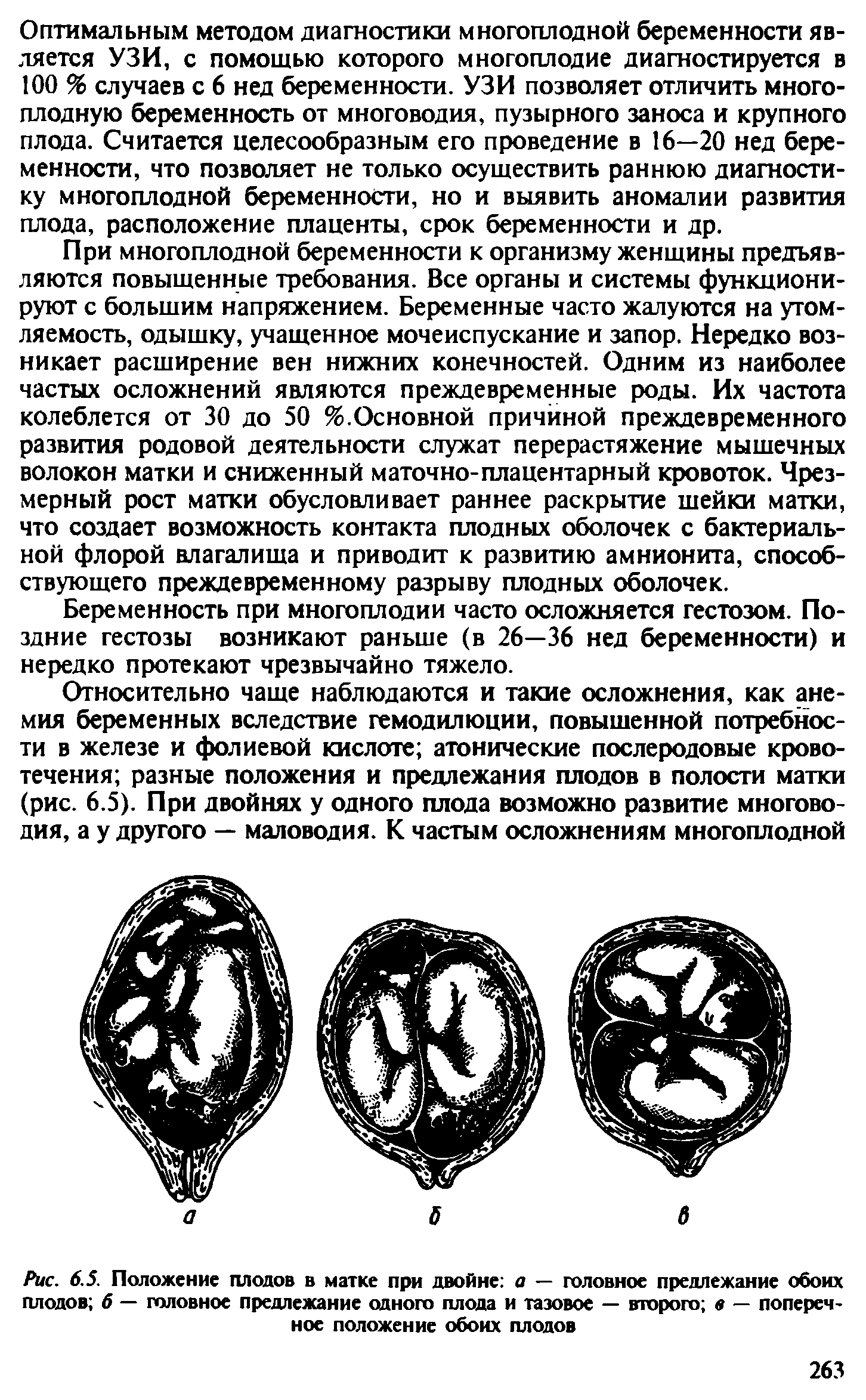 Рис. 6.5. Положение плодов в матке при двойне а — головное предлежание обоих плодов б — головное предлежание одного плода и тазовое — второго в — поперечное положение обоих плодов...