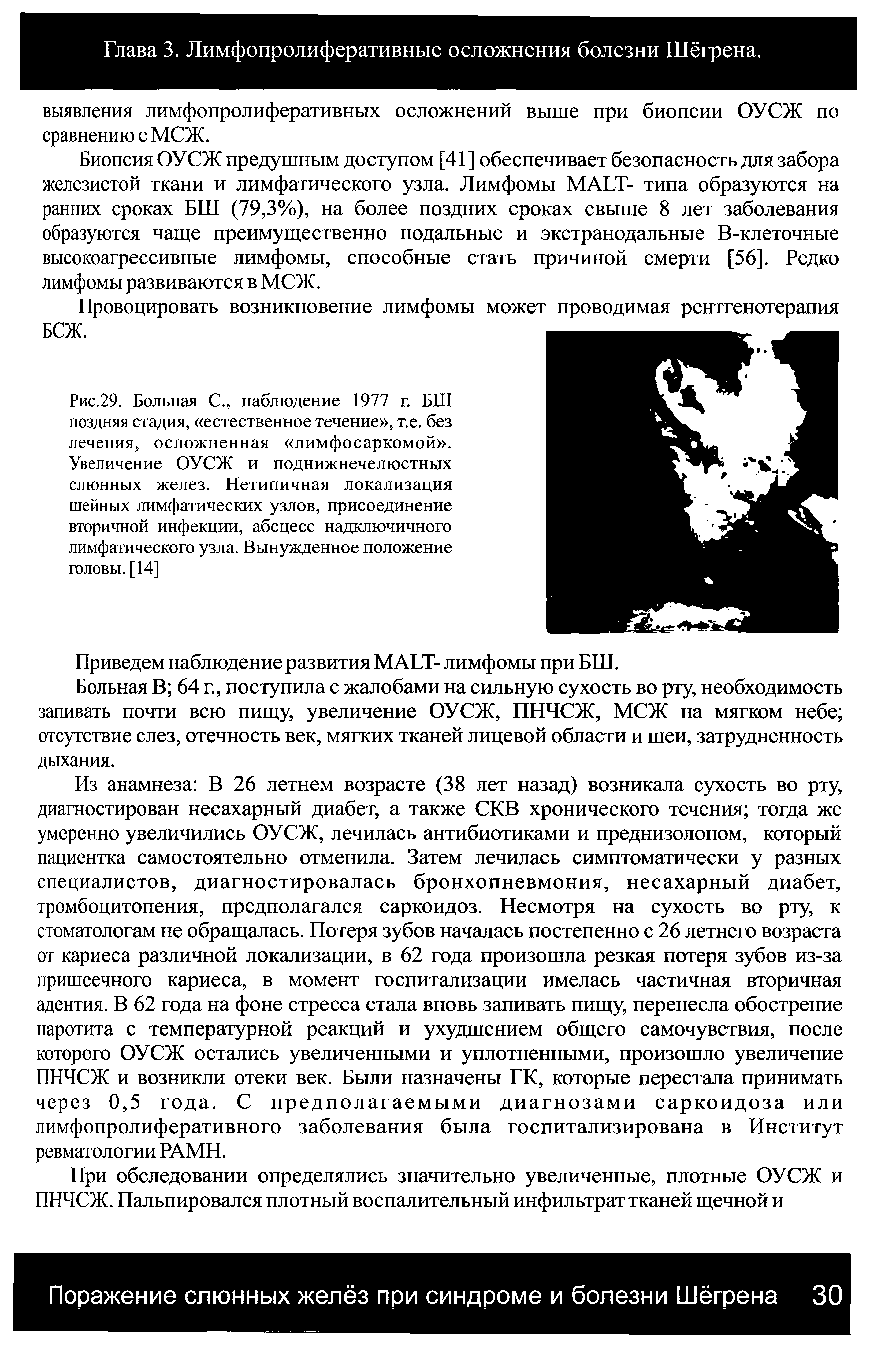 Рис.29. Больная С., наблюдение 1977 г. БШ поздняя стадия, естественное течение , т.е. без лечения, осложненная лимфосаркомой . Увеличение ОУСЖ и поднижнечелюстных слюнных желез. Нетипичная локализация шейных лимфатических узлов, присоединение вторичной инфекции, абсцесс надключичного лимфатического узла. Вынужденное положение головы. [14]...