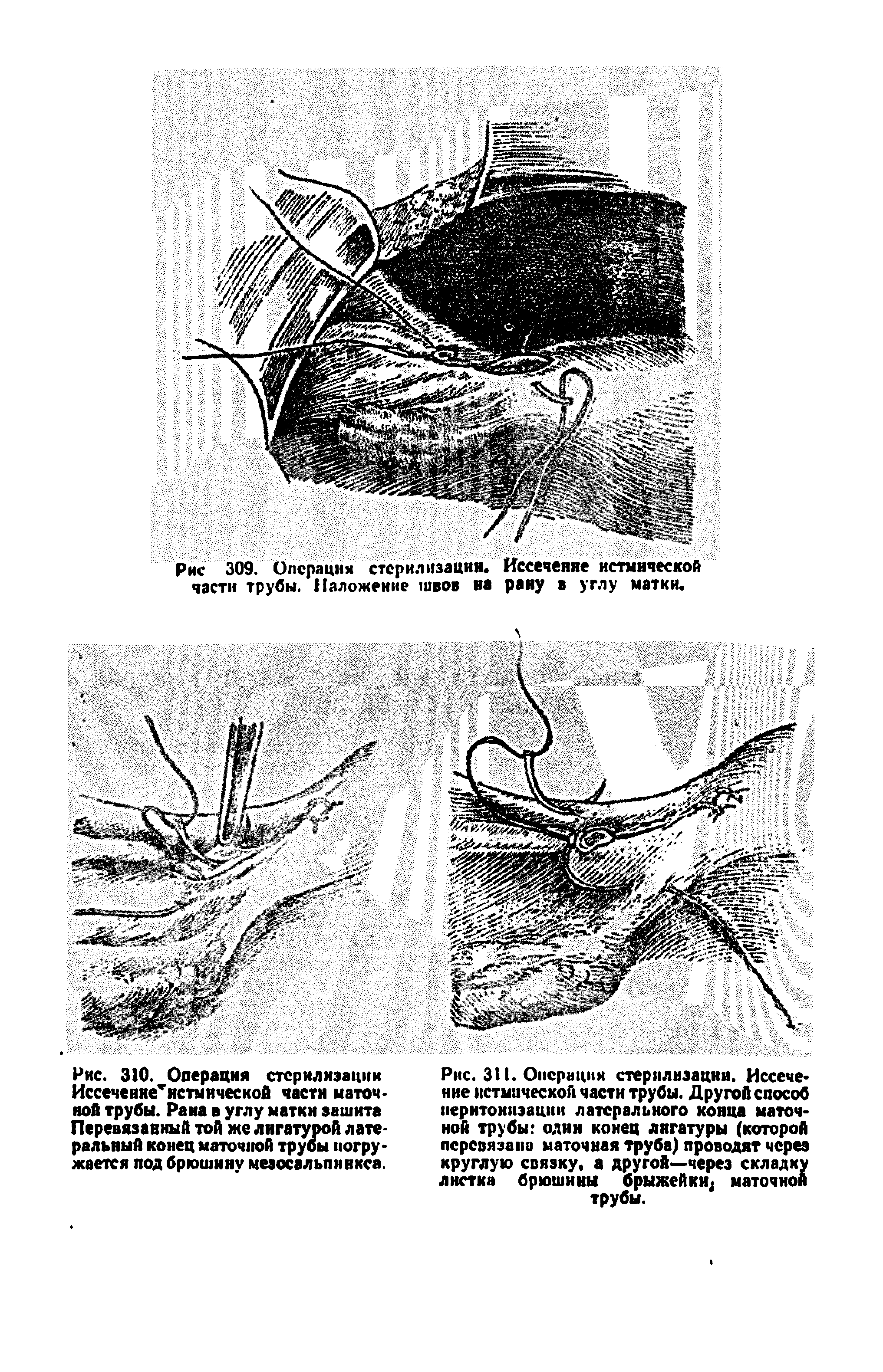 Рис. 311. Операция стерилизации. Иссечение нстмической части трубы. Другой способ перитонизации латерального конца маточной трубы один конец лигатуры (которой перевязана маточная труба) проводят через круглую связку, а другой—через складку листка брюшины брыжейки маточной трубы.