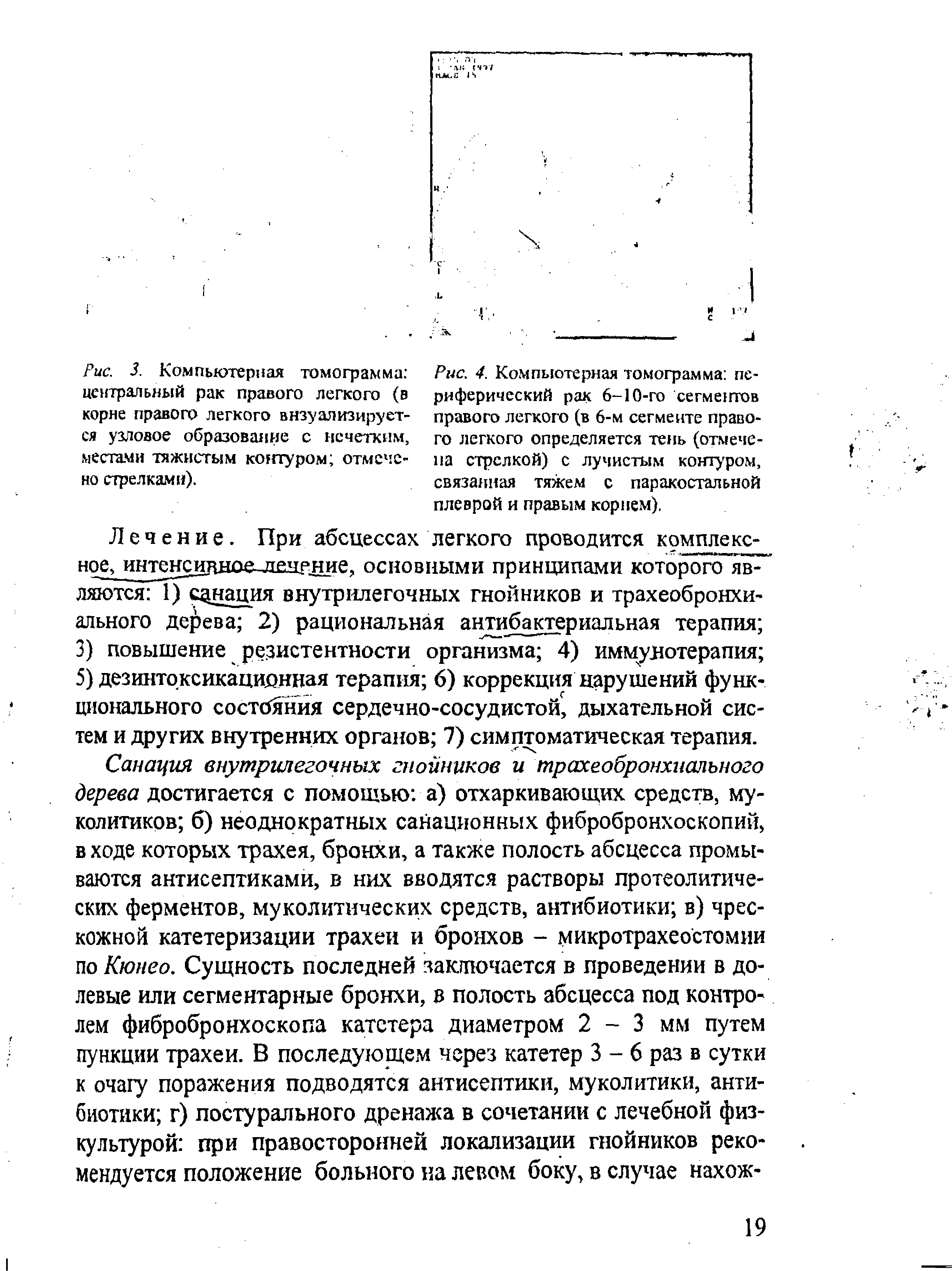 Рис. 3. Компьютерная томограмма центральный рак правого легкого (в корне правого легкого визуализируется узловое образование с нечетким, местами тяж истым контуром отмечено стрелками).