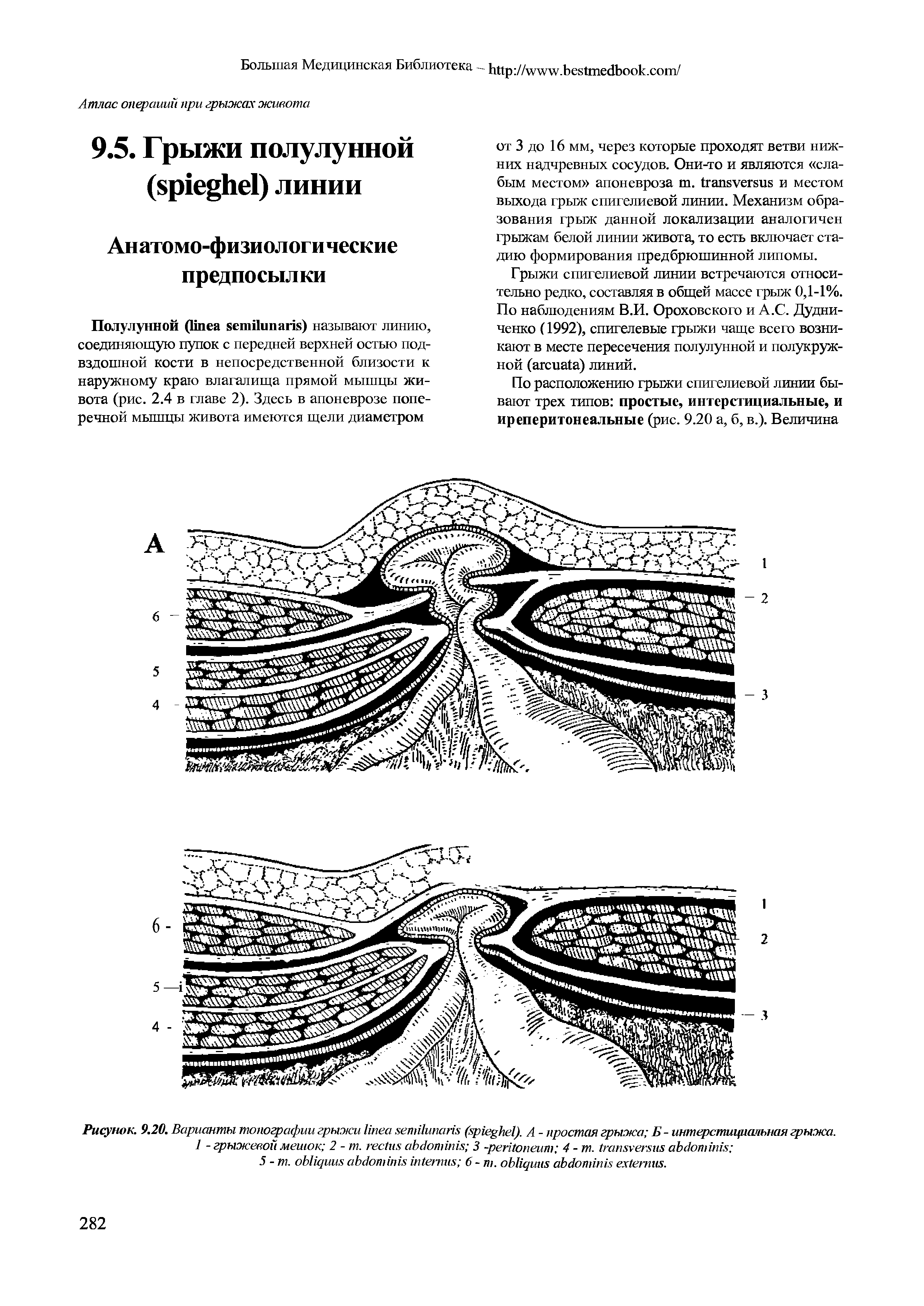 Рисунок. 9.20. Варианты топографии грыжи ( ). А - простая грыжа Б - интерстициа 1Ы1ая грыжа.